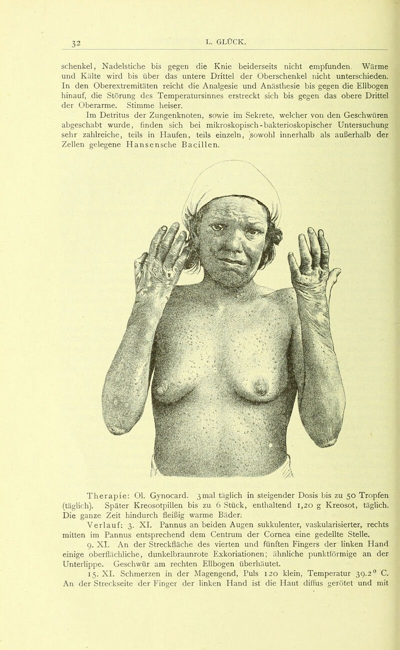 Schenkel, Nadelstiche bis gegen die Knie beiderseits nicht empfunden, Wärme und Kälte wird bis über das untere Drittel der Oberschenkel nicht unterschieden. In den Oberextremitäten reicht die Analgesie und Anästhesie bis gegen die Ellbogen hinauf, die Störung des Temperatursinnes erstreckt sich bis gegen das obere Drittel der Oberarme. Stimme heiser. Im Detritus der Zungenknoten, sowie im Sekrete, welcher von den Geschwüren abgeschabt wurde, finden sich bei mikroskopisch-bakterioskopischer Untersuchung sehr zahlreiche, teils in Haufen, teils einzeln, sowohl innerhalb als außerhalb der Zellen gelegene Hansensche Bacillen. Therapie: Ol. Gynocard. 3inal täglich in steigender Dosis bis zu 50 Tropfen (täglich). Später Kreosotpillen bis zu 6 Stück, enthaltend 1,20 g Kreosot, täglich. Die ganze Zeit hindurch fleißig warme Bäder; Verlauf: 3. XI. Pannus an beiden Augen sukkulenter, vaskularisierter, rechts mitten im Pannus entsprechend dem Centrum der Cornea eine gedeihe Stelle. 9. XI. An der Streckfläche des vierten und fünften Fingers der linken Hand einige oberflächliche, dunkelbraunrote Exkoriationen; ähnliche punktförmige an der Unterlippe. Geschwür am rechten Ellbogen überhäutet. 15. XI. Schmerzen in der Magengend, Puls 120 klein, Temperatur 39.2'’ C. An der Streckseite der Finger der linken Hand ist die Haut diffus gerötet und mit