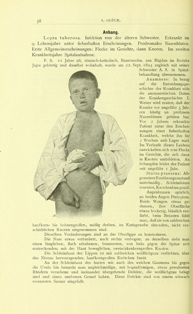 Anhang. Lepra tuberosa. Infektion von der älteren Schwester. Erkrankt im 9. Lebensjahre unter fieberhaften Erscheinungen. Prodromales Nasenbluten. Erste Allgemeinerscheinungen: Flecke im Gesichte, dann Knoten. Im zweiten Krankheitsjahre Spitalaufnahme. F. S. II Jahre alt, römisch-katholisch, Bauernsohn, aus Majdan im Bezirke Jajce gebürtig und daselbst wohnhaft, wurde am 22. Sept. 1894 zugleich mit seiner Schwester A. S. in Spital- behandlung übernommen. Anamnese: In bezug auf die Entstehungsge- schichte der Krankheit vide die anamnestischen Daten der Krankengeschichte I. Weiter wird eruiert, daß der Kranke vor ungefähr 3 Jah- ren häufig an profusem Nasenbluten gelitten hat. Vor 2 Jahren erkrankte Patient unter den Erschei- nungen einer fieberhaften Krankheit, welche ihn für 2 Wochen aufs Lager warf. Im Verlaufe dieses Leidens entwickelten sich rote Flecke im Gesichte, die sich dann in Knoten umbildeten. An Schnupfen leidet der Patient seit ungefähr i Jahr. Status praesens: All- gemeiner Ernährungszustand mittelmäßig, Schleimhäute rosenrot, Knochenbau grazil. Augenbrauen spärlich, an beiden Augen Pterygium. Beide Wangen etwas ge- dunsen, ihre Oberfläche etwas höckerig, bläulich ver- färbt, beim Betasten fühlt man, daß sie von zahlreichen hanfkorn- bis bohnengroßen, mäßig derben, im Kutisgewebe sitzenden, nicht ver- schieblichen Knoten eingenommen sind. Dieselben Veränderungen sind an der Oberlippe zu konstatieren. Die Nase etwas verbreitert, nach rechts verbogen; an derselben sieht man einen länglichen, flach erhabenen, braunroten, von links gegen die Spitze sich erstreckenden, mit der Haut beweglichen, zwetschkenkerngroßen Knoten. Die Schleimhaut der Lippen ist mit zahlreichen weißlichgrau verfärbten, über das Niveau hervorragenden, hanfkorngroßen Knötchen besät. An der Schleimhaut des harten wie auch des weichen Gaumens bis gegen die Uvula hin bemerkt man ungleichmäßige, mit bogenförmigen, etwas gewulsteten Rändern versehene und ineinander übergehende Defekte, die weißlichgrau belegt sind und einen unebenen Grund haben. Diese Defekte sind von einem schwach rosenroten Saume eingefaßt.