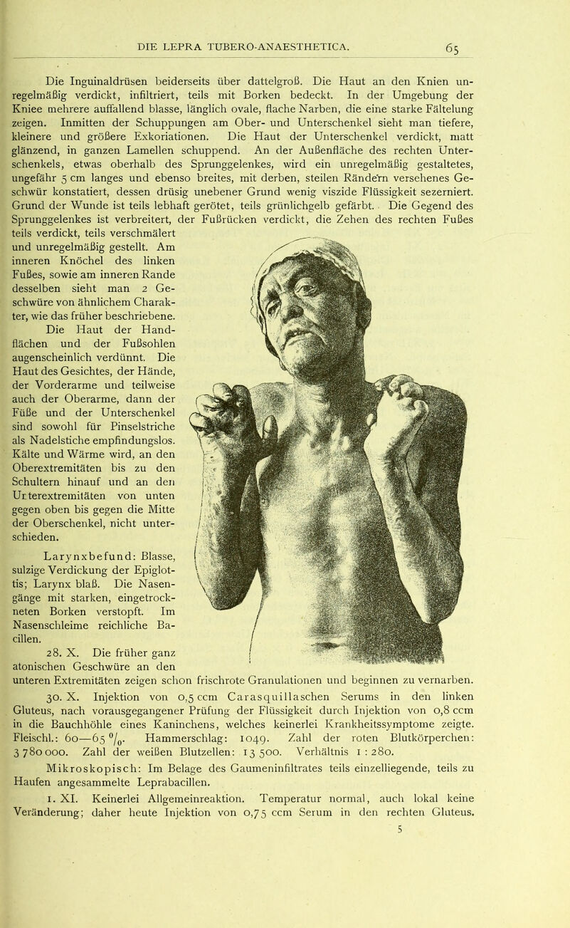 Die Inguinaldrüsen beiderseits über dattelgroß. Die Haut an den Knien un- regelmäßig verdickt, infiltriert, teils mit Borken bedeckt. In der Umgebung der Kniee mehrere auffallend blasse, länglich ovale, flache Narben, die eine starke Fältelung zeigen. Inmitten der Schuppungen am Ober- und Unterschenkel sieht man tiefere, kleinere und größere Exkoriationen. Die Haut der Unterschenkel verdickt, matt glänzend, in ganzen Lamellen schuppend. An der Außenfläche des rechten Unter- schenkels, etwas oberhalb des Sprunggelenkes, wird ein unregelmäßig gestaltetes, ungefähr 5 cm langes und ebenso breites, mit derben, steilen Rändern versehenes Ge- schwür konstatiert, dessen drüsig unebener Grund wenig viszide Flüssigkeit sezerniert. Grund der Wunde ist teils lebhaft gerötet, teils grünlichgelb gefärbt. Die Gegend des Sprunggelenkes ist verbreitert, der Fußrücken verdickt, die Zehen des rechten Fußes teils verdickt, teils verschmälert und unregelmäßig gestellt. Am inneren Knöchel des linken Fußes, sowie am inneren Rande desselben sieht man 2 Ge- schwüre von ähnlichem Charak- ter, wie das früher beschriebene. Die Haut der Hand- flächen und der Fußsohlen augenscheinlich verdünnt. Die Haut des Gesichtes, der Hände, der Vorderarme und teilweise auch der Oberarme, dann der Füße und der Unterschenkel sind sowohl für Pinselstriche als Nadelstiche empfindungslos. Kälte und Wärme wird, an den Oberextremitäten bis zu den Schultern hinauf und an den Urterextremitäten von unten gegen oben bis gegen die Mitte der Oberschenkel, nicht unter- schieden. Larynxbefund: Blasse, sulzige Verdickung der Epiglot- tis; Larynx blaß. Die Nasen- gänge mit starken, eingetrock- neten Borken verstopft. Im Nasenschleime reichliche Ba- cillen. 28. X. Die früher ganz atonischen Geschwüre an den unteren Extremitäten zeigen schon frischrote Granulationen und beginnen zu vernarben. 30.x. Injektion von 0,5 ccm Carasquillaschen Serums in den linken Gluteus, nach vorausgegangener Prüfung der Flüssigkeit durch Injektion von 0,8 ccm in die Bauchhöhle eines Kaninchens, welches keinerlei Krankheitssymptome zeigte. Fleischl.: 60—65 °/q. Hammerschlag: 104g. Zahl der roten Blutkörperchen: 3780000. Zahl der w'eißen Blutzellen: 13500. Verhältnis 1:280. Mikroskopisch; Im Belage des Gaumeninfiltrates teils einzelliegende, teils zu Haufen angesammelte Leprabacillen. I. XI. Keinerlei Allgemeinreaktion. Temperatur normal, auch lokal keine Veränderung; daher heute Injektion von 0,75 ccm Serum in den rechten Gluteus. 5