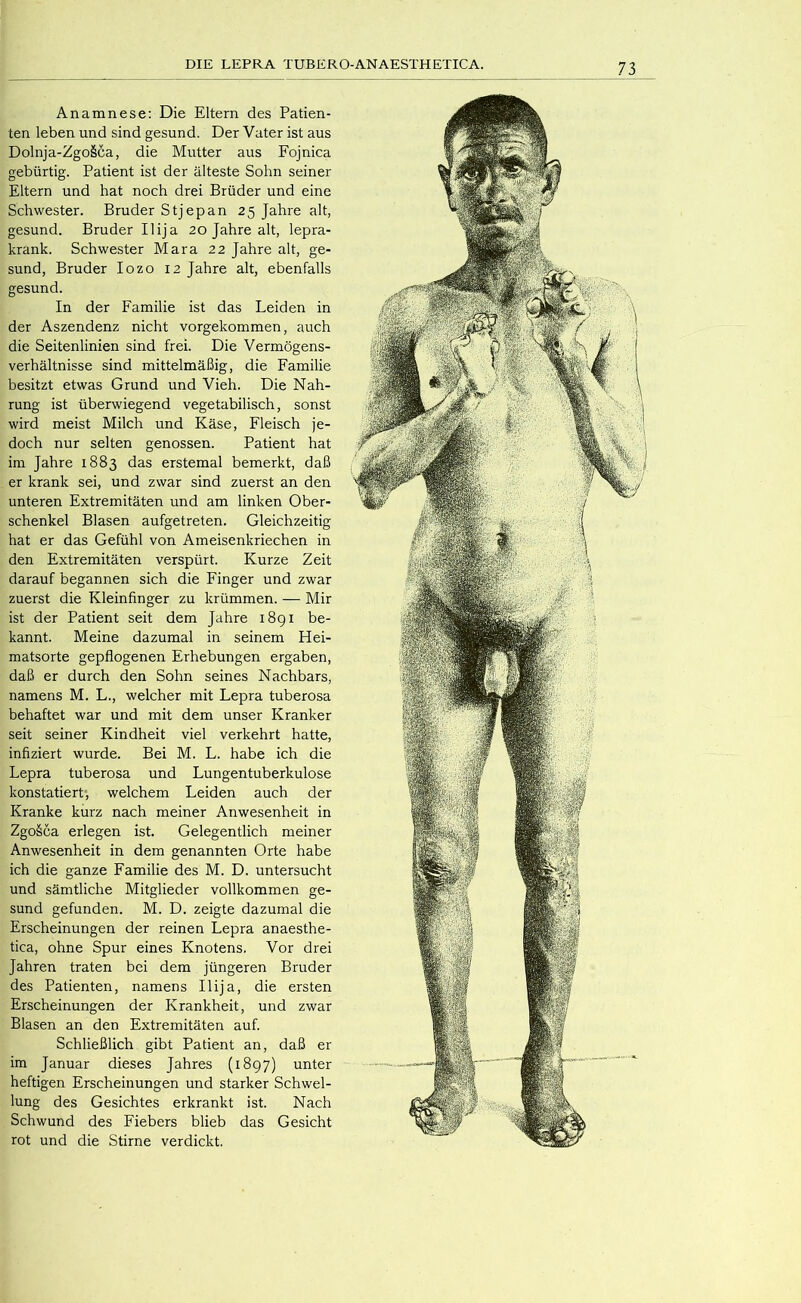 Anamnese: Die Eltern des Patien- ten leben und sind gesund. Der Vater ist aus Dolnja-Zgo§ca, die Mutter aus Fojnica gebürtig. Patient ist der älteste Sohn seiner Eltern und hat noch drei Brüder und eine Schwester. Bruder Stjepan 25 Jahre alt, gesund. Bruder Ilija 20 Jahre alt, lepra- krank. Schwester Mara 22 Jahre alt, ge- sund, Bruder lozo 12 Jahre alt, ebenfalls gesund. In der Familie ist das Leiden in der Aszendenz nicht vorgekommen, auch die Seitenlinien sind frei. Die Vermögens- verhältnisse sind mittelmäßig, die Familie besitzt etwas Grund und Vieh. Die Nah- rung ist überwiegend vegetabilisch, sonst wird meist Milch und Käse, Fleisch je- doch nur selten genossen. Patient hat im Jahre 1883 das erstemal bemerkt, daß er krank sei, und zwar sind zuerst an den unteren Extremitäten und am linken Ober- schenkel Blasen aufgetreten. Gleichzeitig hat er das Gefühl von Ameisenkriechen in den Extremitäten verspürt. Kurze Zeit darauf begannen sich die Finger und zwar zuerst die Kleinfinger zu krümmen. — Mir ist der Patient seit dem Jahre i8gi be- kannt. Meine dazumal in seinem Hei- matsorte gepflogenen Erhebungen ergaben, daß er durch den Sohn seines Nachbars, namens M. L., welcher mit Lepra tuberosa behaftet war und mit dem unser Kranker seit seiner Kindheit viel verkehrt hatte, infiziert wurde. Bei M. L. habe ich die Lepra tuberosa und Lungentuberkulose konstatiert, welchem Leiden auch der Kranke kurz nach meiner Anwesenheit in Zgoäca erlegen ist. Gelegentlich meiner Anwesenheit in dem genannten Orte habe ich die ganze Familie des M. D. untersucht und sämtliche Mitglieder vollkommen ge- sund gefunden. M. D. zeigte dazumal die Erscheinungen der reinen Lepra anaesthe- tica, ohne Spur eines Knotens. Vor drei Jahren traten bei dem jüngeren Bruder des Patienten, namens Ilija, die ersten Erscheinungen der Krankheit, und zwar Blasen an den Extremitäten auf Schließlich gibt Patient an, daß er im Januar dieses Jahres (1897) unter heftigen Erscheinungen und starker Schwel- lung des Gesichtes erkrankt ist. Nach Schwund des Fiebers blieb das Gesicht rot und die Stirne verdickt.