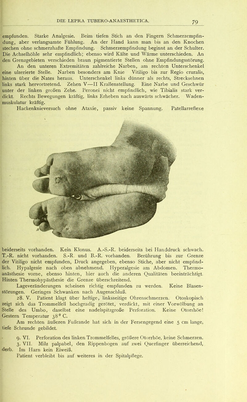 empfunden. Starke Analgesie. Beim tiefen Stich an den Fingern Schmerzempfin- dung, aber verlangsamte Fühlung. An der Hand kann man bis an den Knochen stechen ohne schmerzhafte Empfindung. Schmerzempfindung beginnt an der Schulter. Die Achselhöhle sehr empfindlich; ebenso wird Kälte und Wärme unterschieden. An den Grenzgebieten verschieden braun pigmentierte Stellen ohne Empfindungsstörung. An den unteren Extremitäten zahlreiche Narben, am rechten Unterschenkel eine ulzerierte Stelle. Narben besonders am Knie Vitiligo bis zur Regio cruralis, hinten über die Nates heraus. Unterschenkel links dünner als rechts, Strecksehnen links stark hervortretend. Zehen V—II Krallenstellung. Eine Narbe und Geschwür unter der linken großen Zehe. Peronei nicht empfindlich, wie Tibialis stark ver- dickt. Rechts Bewegungen kräftig, links Erheben nach auswärts schwächer. Waden- muskulatur kräftig. Hackenknieversuch ohne Ataxie, passiv keine Spannung. Patellarreflexe beiderseits vorhanden. Kein Klonus. A.-S.-R. beiderseits bei Planddruck schwach. T.-R. nicht vorhanden. S.-R. und B.-R. vorhanden. Berührung bis zur Grenze der Vitiligo nicht empfunden, Druck angegeben, ebenso Stiche, aber nicht empfind- lich. Hypalgesie nach oben abnehmend. Flyperalgesie am Abdomen. Thermo- anästhesie vorne, ebenso hinten, hier auch die anderen Qualitäten beeinträchtigt. Hinten Thermohypästhesie die Grenze überschreitend. Lageveränderungen scheinen richtig empfunden zu werden. Keine Blasen- störungen. Geringes Schwanken nach Augenschluß. 28. V. Patient klagt über heftige, linksseitige Ohrenschmerzen. Otoskopisch zeigt sich das Trommelfell hochgradig gerötet, verdickt, mit einer Vorwölbung an Stelle des Umbo, daselbst eine nadelspitzgroße Perforation. Keine Otonhöe! Gestern Temperatur 38° C. Am rechten äußeren Fußrande hat sich in der Fersengegend eine 5 cm lange, tiefe Schrunde gebildet. 9. VI. Perforation des linken Trommelfelles, größere Otorrhöe, keine Schmerzen. 3. VII. Milz palpabel, den Rippenbogen auf zwei Querfinger überreichend, derb. Im Harn kein Eiweiß. Patient verbleibt bis auf weiteres in der Spitalpflege.