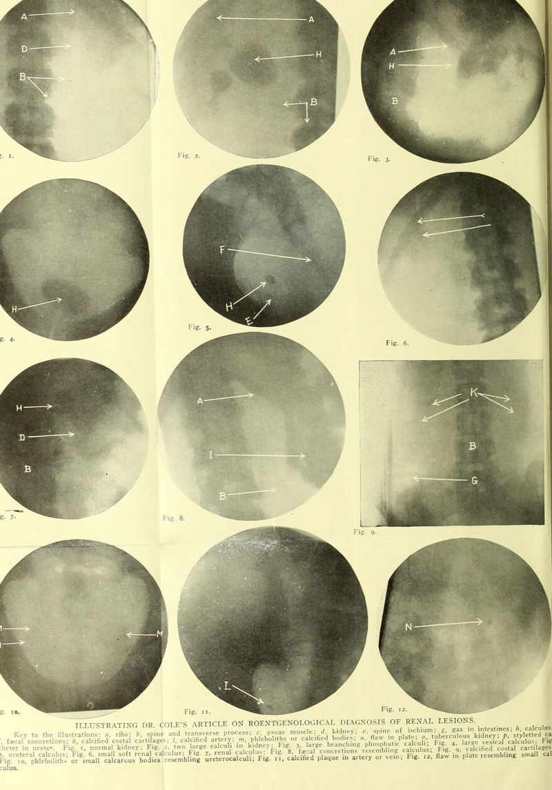 Fig. 12. ILLUSTRATING DR. COLE’S ARTICLE ON ROENTGENOLOGICAL DIAGNOSIS OF RENAL LESIONS. — i, normal^ Kiuncy , i ig. t T7- _ ,1 Trio- 8 rnnrrpfinns resemblin£ calculus rig. Key to the ■Za\nZ%tTnFig: x, normal kidney; Fig! 2, two large calculi in kffney; 1-tg 3. large o«ncmng ‘tlg.’b/caldfed'cost'al'Cartilages gUrfoTphleWhhs: ^^sman™aicarousr^^ies|resembHng Sreterocalculi; Fig. £ calcified plaque in artery or ve:n; Fig. .a, flaw in plate resembling small cal I-ig Fig. 6. Fig. Fig. 9.