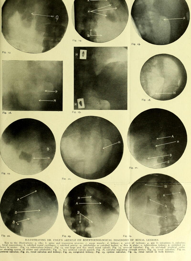 ILLUSTRATING DR. COLE’S ARTICLE ON ROENTGENOLOGICAL DIAGNOSIS OF RENAL LESIONS. Key to the illustrations: a, ribs; b, spine and transverse process; c, psoas muscle; d, kidney; e, spine of ischium; g, gas in intestines; h, calculus; , faecal concretions; It, calcified costal cartilages: l, calcified artery; m, phleboliths or calcified bodies; n, flaw in plate; o, tuberculous kidney; p, styletted ca- heter in ureter. Fig. 13, tuberculous kidney; F'ig. 14, one large and five small renal calculi; Fig. 15, ureteral calculus; Fig. 16, styletted urethral cathe- :er showing course of ureter and phlebolith; Fig. 17, two ureteral calculi passed; Fig. 18, calculus migrating through ureter; Fig. 19, renal calculus; Fig. 20, jreteral calculus; Fig. 21, renal calculus and kidney; Fig. 22, congested kidney; Fig. 23, cystine calculus; Fig. 24, renal calculi in both kidneys.