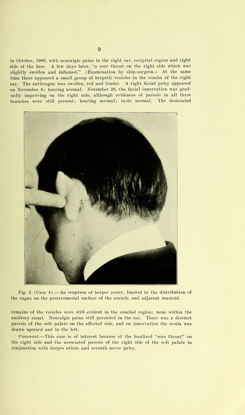 in October, 1909, with neuralgic pains in the right ear, occipital region and right side of the face. A few days later, “a sore throat on the right side which was slightly swollen and inflamed.” (E.\amination by ship-surgeon.) At the same time there appeared a small group of herpetic vesicles in the concha of the right ear. The antitragus was swollen, red and tender. A right facial palsy appeared on November 6; hearing normal. November 26, the facial innervation was grad- ually improving on the right side, although evidences of paresis in all three branches were still present; hearing normal; taste normal. The desiccated Fig. 5 (Case 4).—An eruption of her])es zoster, limited to the distribution of the vagus on the posteromesial surface of the auricle, and adjacent mastoid. remains of the vesicles were still evident in the concha! region; none within the auditory canal. Neuralgic pains still persisted in the ear. There was a distinct paresis of the soft palate on the affected side, and on innervation the uvula was drawn upward and to the left. Comment.—This case is of interest because of the localized “sore throat” on the right side and the associated paresis of the right side of the soft palate in conjunction with herpes oticus and seventh nerve palsy.