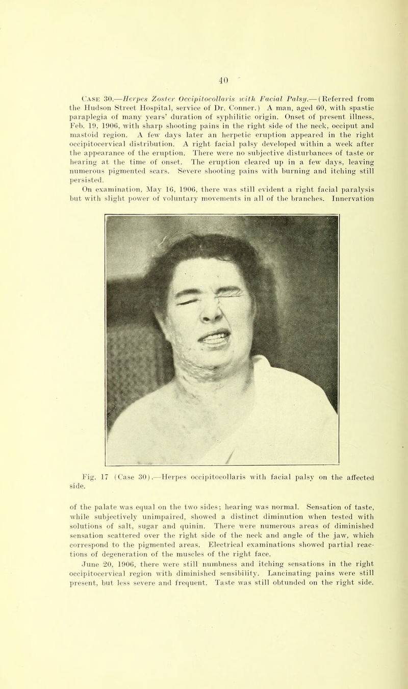 Case 30.—Herpes Zosler Occipitocollaris witli Facial Palsy.— (Referred from the Hudson Street Hospital, service of Dr. Connor.) A man, aged 60, witli spastic paraplegia of many years’ duration of syphilitic origin. Onset of present illness, Fell. 10, 1006, with sharp shooting pains in the right side of the neck, occiput and mastoid region. A few days later an herpetic eruption appeared in the right occipitocervical distiihution. A right facial palsy developed within a week after the appearance of the eruption. There were no subjective disturbances of taste or hearing at the time of onset. The eruption cleared up in a few days, leaving numerous j)igmented scars. Severe shooting ])ains with burning and itching still persisted. On examination. May 16, 1006, there was still evident a right facial paralysis but with slight jiower of voluntary movements in all of Hie branches. Innervation Fig. 17 (Case 30).—Herjies occi|iitocollaris with facial palsy on the affected side. of the palate was equal on the two sides; hearing was normal. Sensation of taste, while subjectively unimpaired, showed a distinct diminution when tested with solutions of salt, sugar and quinin. There were numerous areas of diminished sensation scattered over the right side of the neck and angle of the jaw, which correspond to the pigmented areas. Electrical examinations showed partial reac- tions of degeneration of the muscles of the right face. June 20, 1900, there were still numbness and itching sensations in the right occipitocervical region with diminished sensibility. Lancinating pains were still present, but less severe and frequent. Taste was still obtunded on the right side.