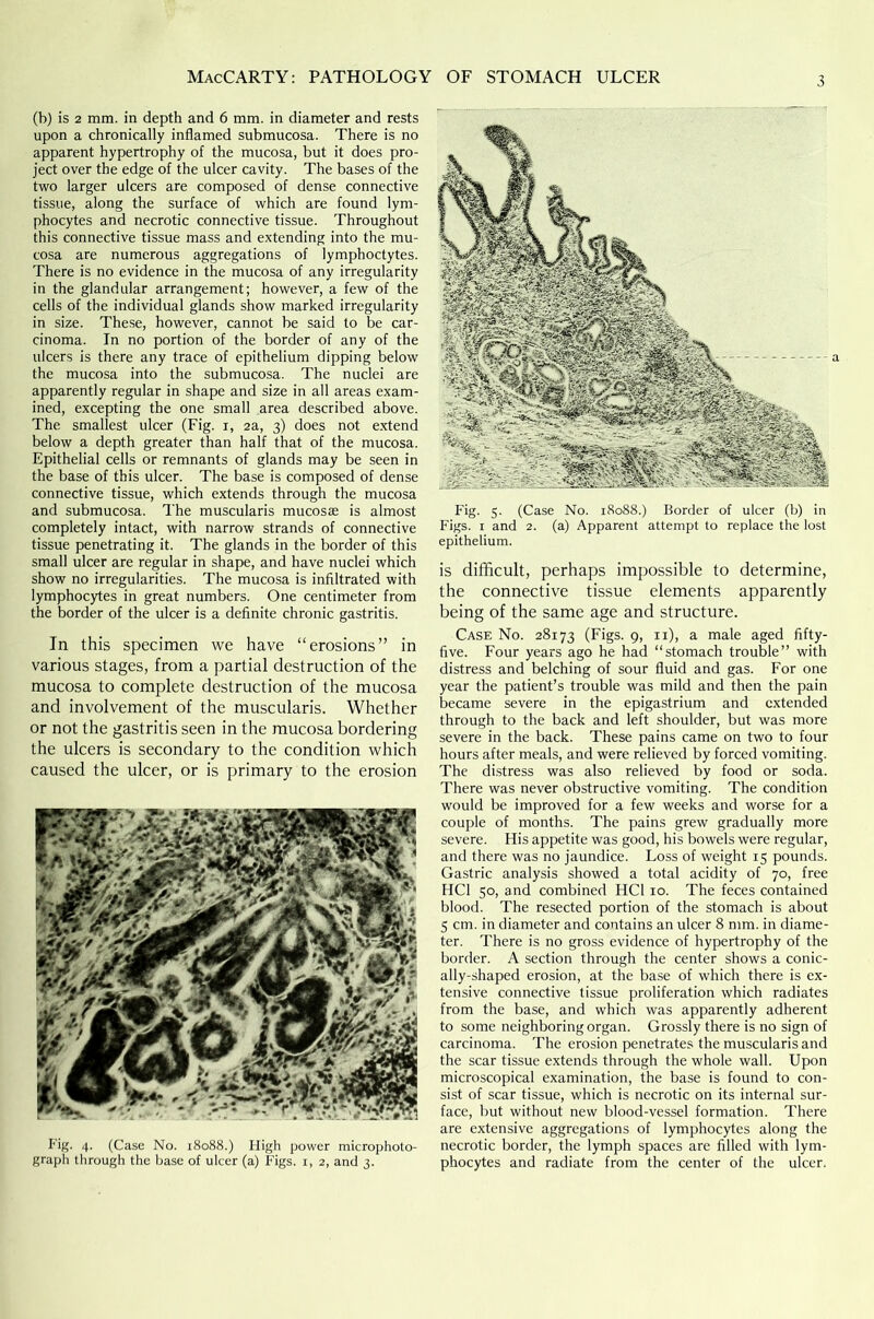 (b) is 2 mm. in depth and 6 mm. in diameter and rests upon a chronically inflamed submucosa. There is no apparent hypertrophy of the mucosa, but it does pro- ject over the edge of the ulcer cavity. The bases of the two larger ulcers are composed of dense connective tissue, along the surface of which are found lym- phocytes and necrotic connective tissue. Throughout this connective tissue mass and extending into the mu- cosa are numerous aggregations of lymphoctytes. There is no evidence in the mucosa of any irregularity in the glandular arrangement; however, a few of the cells of the individual glands show marked irregularity in size. These, however, cannot be said to be car- cinoma. In no portion of the border of any of the ulcers is there any trace of epithelium dipping below the mucosa into the submucosa. The nuclei are apparently regular in shape and size in all areas exam- ined, excepting the one small area described above. The smallest ulcer (Fig. x, 2a, 3) does not extend below a depth greater than half that of the mucosa. Epithelial cells or remnants of glands may be seen in the base of this ulcer. The base is composed of dense connective tissue, which extends through the mucosa and submucosa. The muscularis mucosae is almost completely intact, with narrow strands of connective tissue penetrating it. The glands in the border of this small ulcer are regular in shape, and have nuclei which show no irregularities. The mucosa is infiltrated with lymphocytes in great numbers. One centimeter from the border of the ulcer is a definite chronic gastritis. In this specimen we have “erosions” in various stages, from a partial destruction of the mucosa to complete destruction of the mucosa and involvement of the muscularis. Whether or not the gastritis seen in the mucosa bordering the ulcers is secondary to the condition which caused the ulcer, or is primary to the erosion Fig. 4. (Case No. 18088.) High power microphoto- graph through the base of ulcer (a) Figs. 1, 2, and 3. Fig. 5. (Case No. 18088.) Border of ulcer (b) in Figs. 1 and 2. (a) Apparent attempt to replace the lost epithelium. is difficult, perhaps impossible to determine, the connective tissue elements apparently being of the same age and structure. Case No. 28173 (Figs. 9> n)> a male aged fifty- five. Four years ago he had “stomach trouble” with distress and belching of sour fluid and gas. For one year the patient’s trouble was mild and then the pain became severe in the epigastrium and extended through to the back and left shoulder, but was more severe in the back. These pains came on two to four hours after meals, and were relieved by forced vomiting. The distress was also relieved by food or soda. There was never obstructive vomiting. The condition would be improved for a few weeks and worse for a couple of months. The pains grew gradually more severe. His appetite was good, his bowels were regular, and there was no jaundice. Loss of weight 15 pounds. Gastric analysis showed a total acidity of 70, free HC1 50, and combined IICl 10. The feces contained blood. The resected portion of the stomach is about 5 cm. in diameter and contains an ulcer 8 mm. in diame- ter. There is no gross evidence of hypertrophy of the border. A section through the center shows a conic- ally-shaped erosion, at the base of which there is ex- tensive connective tissue proliferation which radiates from the base, and which was apparently adherent to some neighboring organ. Grossly there is no sign of carcinoma. The erosion penetrates the muscularis and the scar tissue extends through the whole wall. Upon microscopical examination, the base is found to con- sist of scar tissue, which is necrotic on its internal sur- face, but without new blood-vessel formation. There are extensive aggregations of lymphocytes along the necrotic border, the lymph spaces are filled with lym- phocytes and radiate from the center of the ulcer.