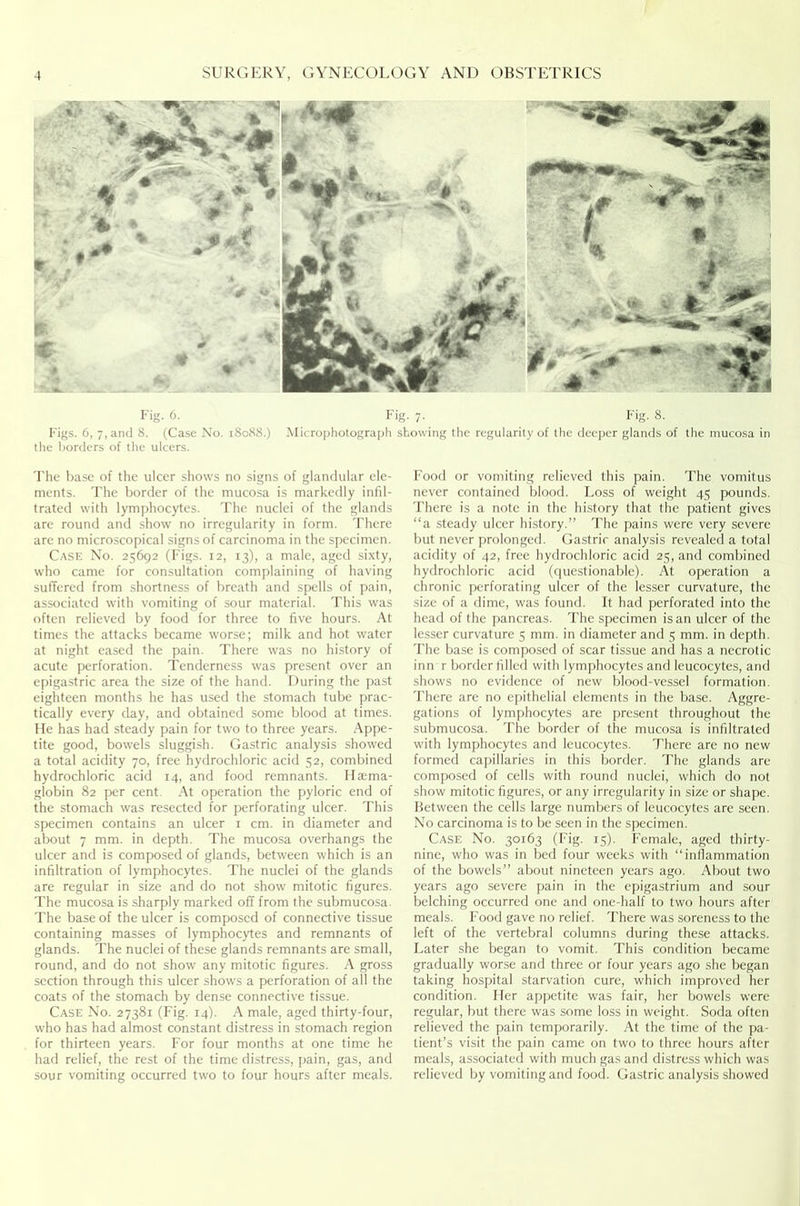 Fig. 6. Fig. 7. Fig. 8. Figs. 6, 7, and 8. (Case No. 18088.) Microphotograph showing the regularity of the deeper glands of the mucosa in the borders of the ulcers. The base of the ulcer shows no signs of glandular ele- ments. The border of the mucosa is markedly infil- trated with lymphocytes. The nuclei of the glands are round and show no irregularity in form. There are no microscopical signs of carcinoma in the specimen. Case No. 25692 (Figs. 12, 13), a male, aged sixty, who came for consultation complaining of having suffered from shortness of breath and spells of pain, associated with vomiting of sour material. This was often relieved by food for three to five hours. At times the attacks became worse; milk and hot water at night eased the pain. There was no history of acute perforation. Tenderness was present over an epigastric area the size of the hand. During the past eighteen months he has used the stomach tube prac- tically every day, and obtained some blood at times. He has had steady pain for two to three years. Appe- tite good, bowels sluggish. Gastric analysis showed a total acidity 70, free hydrochloric acid 52, combined hydrochloric acid 14, and food remnants. Iltema- globin 82 per cent. At operation the pyloric end of the stomach was resected for perforating ulcer. This specimen contains an ulcer 1 cm. in diameter and about 7 mm. in depth. The mucosa overhangs the ulcer and is composed of glands, between which is an infiltration of lymphocytes. The nuclei of the glands are regular in size and do not show mitotic figures. The mucosa is sharply marked off from the submucosa. The base of the ulcer is composed of connective tissue containing masses of lymphocytes and remnants of glands. The nuclei of these glands remnants are small, round, and do not show any mitotic figures. A gross section through this ulcer shows a perforation of all the coats of the stomach by dense connective tissue. Case No. 27381 (Fig. 14). A male, aged thirty-four, who has had almost constant distress in stomach region for thirteen years. For four months at one time he had relief, the rest of the time distress, pain, gas, and sour vomiting occurred two to four hours after meals. Food or vomiting relieved this pain. The vomitus never contained blood. Loss of weight 45 pounds. There is a note in the history that the patient gives “a steady ulcer history.” The pains were very severe but never prolonged. Gastric analysis revealed a total acidity of 42, free hydrochloric acid 25, and combined hydrochloric acid (questionable). At operation a chronic perforating ulcer of the lesser curvature, the size of a dime, was found. It had perforated into the head of the pancreas. The specimen is an ulcer of the lesser curvature 5 mm. in diameter and 5 mm. in depth. The base is composed of scar tissue and has a necrotic inn r border filled with lymphocytes and leucocytes, and shows no evidence of new blood-vessel formation. There are no epithelial elements in the base. Aggre- gations of lymphocytes are present throughout the submucosa. The border of the mucosa is infiltrated with lymphocytes and leucocytes. There are no new formed capillaries in this border. The glands are composed of cells with round nuclei, which do not show mitotic figures, or any irregularity in size or shape. Between the cells large numbers of leucocytes are seen. No carcinoma is to be seen in the specimen. Case No. 30163 (Fig. 15). Female, aged thirty- nine, who was in bed four weeks with “inflammation of the bowels” about nineteen years ago. About two years ago severe pain in the epigastrium and sour belching occurred one and one-half to two hours after meals. Food gave no relief. There was soreness to the left of the vertebral columns during these attacks. Later she began to vomit. This condition became gradually worse and three or four years ago she began taking hospital starvation cure, which improved her condition. Her appetite was fair, her bowels were regular, but there was some loss in weight. Soda often relieved the pain temporarily. At the time of the pa- tient’s visit the pain came on two to three hours after meals, associated with much gas and distress which was relieved by vomiting and food. Gastric analysis showed