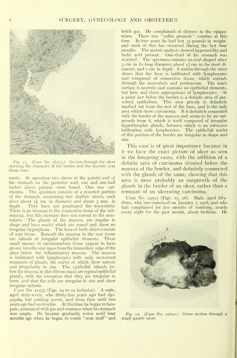 Fig. ii. (Case No. 28173.) Section through the ulcer showing the character of the border and the necrotic scar tissue base. nants. At operation two ulcers at the pyloric end of the stomach on the posterior wall, one and one-half inches above pylorus were found. One was car- cinoma. The specimen consists of a resected portion of the stomach, containing two shallow ulcers, each ulcer about i\ cm in diameter and about 3 mm. in depth. They have not penetrated the muscularis. There is an increase in the connective tissue of the sub- mucosa, but this increase does not extend to the mus- cularis. The glands of the mucosa are regular in shape and have nuclei which are round and show no irregular hyperplasia. The base of both ulcers consists of scar tissue. Beneath the mucosa in the scar tissue are islands of irregular epithelial elements. These small masses of carcinomatous tissue appear to have grown into the scar mass from the immediate edge of the ulcer below the inflammatory mucosa. The mucosa is infiltrated with lymphocytes with only occasional remnants of glands, the nuclei of which show mitosis and irregularity in size The epithelial islands be- low the mucosa in this fibrous mass are typical epithelial glands, with the exception that they are irregular in form, and that the cells are irregular in size and show irregular mitosis. Case No. 21555 (Figs. T9 t° 24 inclusive). A male, aged sixty-seven, who thirty-five years ago had dys- pepsia, but nothing severe, and from then until two years ago had no trouble. At this time he began to have pain, associated with gas and sourness when his stomach was empty. He became gradually worse until four months ago when he began to vomit “sour stuff” and belch gas. He complained of distress in the epigas- trium. There was “coffee grounds” \omitus at this time. In two years he had lost 35 pounds in weight, and most of this has occurred during the last four months. The gastric analysis showed hyperacidity and lactic acid present. One-third of his stomach was resected. The specimen contains an oval-shaped ulcer 3 cm. in its long diameter, about 1$ cm. in the short di- ameter, and 1 cm. in depth. A section through the ulcer shows that the base is infiltrated with lymphocytes and composed of connective tissue, which extends through the muscularis and peritoneum. The inner surface is necrotic and contains no epithelial elements, but here and there aggregations of lymphocytes. At a point just below the border is a definite area of per- verted epithelium. This area grossly is definitely marked out from the rest of the base, and is the only area which shows carcinoma. It is definitely connected with the border of the mucosa and seems to be an out- growth from it, which is itself composed of irregular hyperthrophic glands, between which is an extensive infiltration with lymphocytes. The epithelial nuclei of this portion of the border are irregular in shape and size. This case is of great importance because in it we have the exact picture of ulcer as seen in the foregoing cases, with the addition of a definite area of carcinoma situated below the mucosa of the border, and definitely connected with the glands of the same, showing that this area is most probably an outgrowth of the glands in the border of an ulcer, rather than a remnant of an ulcerating carcinoma. Case No. 24527 (Figs. 25, 26). Male, aged fifty- three, who was examined on January 7, 1908, and who had complained for five months of vomiting, nearly every night for the past month, about bedtime. He * Fig. 12. (Case No. 25692.) Gross section through a single gastric ulcer.