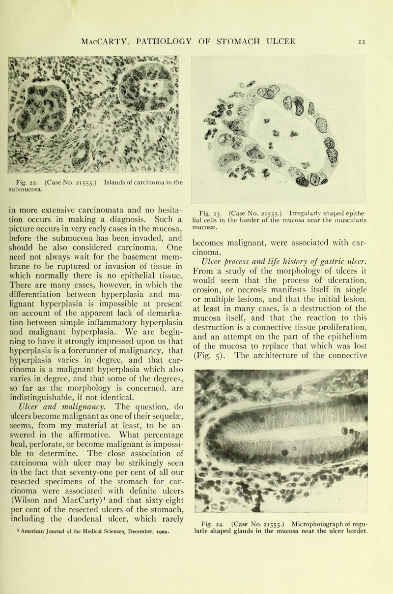 Fig. 22. (Case No. 21555.) Islands of carcinoma in the submucosa. in more extensive carcinomata and no hesita- tion occurs in making a diagnosis. Such a picture occurs in very early cases in the mucosa, before the submucosa has been invaded, and should be also considered carcinoma. One need not always wait for the basement mem- brane to be ruptured or invasion of tissue in which normally there is no epithelial tissue. There are many cases, however, in which the differentiation between hyperplasia and ma- lignant hyperplasia is impossible at present on account of the apparent lack of demarka- tion between simple inflammatory hyperplasia and malignant hyperplasia. We are begin- ning to have it strongly impressed upon us that hyperplasia is a forerunner of malignancy, that hyperplasia varies in degree, and that car- cinoma is a malignant hyperplasia which also varies in degree, and that some of the degrees, so far as the morphology is concerned, are indistinguishable, if not identical. Ulcer and malignancy. The question, do ulcers become malignant as one of their sequelae, seems, from my material at least, to be an- swered in the affirmative. What percentage heal, perforate, or become malignant is impossi- ble to determine. The close association of carcinoma with ulcer may be strikingly seen in the fact that seventy-one per cent of all our resected specimens of the stomach for car- cinoma were associated with definite ulcers (Wilson and MacCarty)1 and that sixty-eight per cent of the resected ulcers of the stomach, including the duodenal ulcer, which rarely 1 American Journal of the Medical Sciences, December, 1909. Fig. 23. (Case No. 21555.) Irregularly shaped epithe- lial cells in the border of the mucosa near the muscularis mucosae. becomes malignant, were associated with car- cinoma. Ulcer process and life history of gastric ulcer. From a study of the morphology of ulcers it would seem that the process of ulceration, erosion, or necrosis manifests itself in single or multiple lesions, and that the initial lesion, at least in many cases, is a destruction of the mucosa itself, and that the reaction to this destruction is a connective tissue proliferation, and an attempt on the part of the epithelium of the mucosa to replace that which was lost (Fig. 5). The architecture of the connective Fig. 24. (Case No. 21555.) Microphotograph of regu- larly shaped glands in the mucosa near the ulcer border.