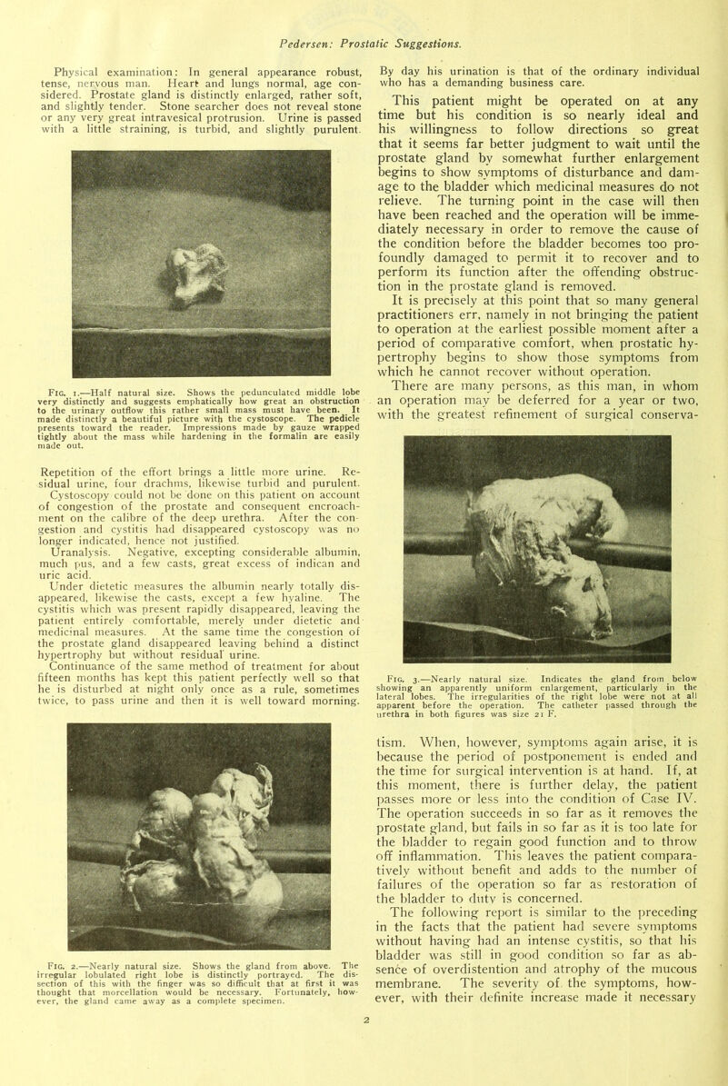 Physical examination: In general appearance robust, tense, nervous man. Heart and lungs normal, age con- sidered. Prostate gland is distinctly enlarged, rather soft, and slightly tender. Stone searcher does not reveal stone or any very great intravesical protrusion. Urine is passed with a little straining, is turbid, and slightly purulent. Fig. i.—Half natural size. Shows the pedunculated middle lobe very distinctly and suggests emphatically how great an obstruction to the urinary outflow this rather small mass must have been. It made distinctly a beautiful picture with the cystoscope. The pedicle presents toward the reader. Impressions made by gauze wrapped tightly about the mass while hardening in the formalin are easily made out. Repetition of the effort brings a little more urine. Re- sidual urine, four drachms, likewise turbid and purulent. Cystoscopy could not be done on this patient on account of congestion of the prostate and consequent encroach- ment on the calibre of the deep urethra. After the con- gestion and cystitis had disappeared cystoscopy was no longer indicated, hence not justified. Uranalysis. Negative, excepting considerable albumin, much pus, and a few casts, great excess of indican and uric acid. Under dietetic measures the albumin nearly totally dis- appeared, likewise the casts, except a few hyaline. The cystitis which was present rapidly disappeared, leaving the patient entirely comfortable, merely under dietetic and medicinal measures. At the same time the congestion of the prostate gland disappeared leaving behind a distinct hypertrophy but without residual urine. Continuance of the same method of treatment for about fifteen months has kept this patient perfectly well so that he is disturbed at night only once as a rule, sometimes twice, to pass urine and then it is well toward morning. Fig. 2.—Nearly natural size. Shows the gland from above. The irregular lobulated right lobe is distinctly portrayed. The dis- section of this with the finger was so difficult that at first it was thought that morcellation would be necessary. Fortunately, how- ever, the gland came away as a complete specimen. By day his urination is that of the ordinary individual who has a demanding business care. This patient might be operated on at any time but his condition is so nearly ideal and his willingness to follow directions so great that it seems far better judgment to wait until the prostate gland by somewhat further enlargement begins to show symptoms of disturbance and dam- age to the bladder which medicinal measures do not relieve. The turning point in the case will then have been reached and the operation will be imme- diately necessary in order to remove the cause of the condition before the bladder becomes too pro- foundly damaged to permit it to recover and to perform its function after the offending obstruc- tion in the prostate gland is removed. It is precisely at this point that so many general practitioners err, namely in not bringing the patient to operation at the earliest possible moment after a period of comparative comfort, when, prostatic hy- pertrophy begins to show those symptoms from which he cannot recover without operation. There are many persons, as this man, in whom an operation may be deferred for a year or two, with the greatest refinement of surgical conserva- Fig. 3.—Nearly natural size. Indicates the gland from _ below showing an apparently uniform enlargement, particularly in the lateral lobes. The irregularities of the right lobe were not at all apparent before the operation. The catheter passed through the urethra in both figures was size 21 F. tism. When, however, symptoms again arise, it is because the period of postponement is ended and the time for surgical intervention is at hand. If, at this moment, there is further delay, the patient passes more or less into the condition of Case IV. The operation succeeds in so far as it removes the prostate gland, but fails in so far as it is too late for the bladder to regain good function and to throw off inflammation. This leaves the patient compara- tively without benefit and adds to the number of failures of the operation so far as restoration of the bladder to duty is concerned. The following report is similar to the preceding in the facts that the patient had severe symptoms without having had an intense cystitis, so that his bladder was still in good condition so far as ab- sence of overdistention and atrophy of the mucous membrane. The severity of the symptoms, how- ever, with their definite increase made it necessary