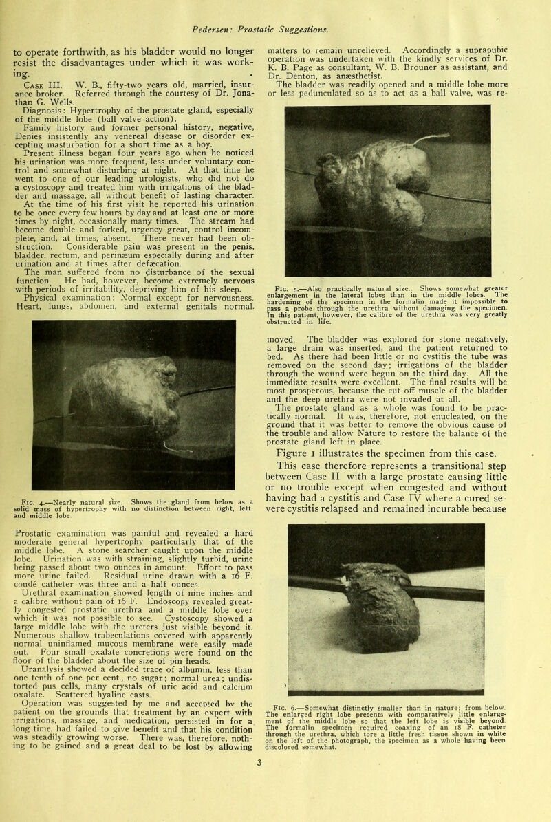 to operate forthwith, as his bladder would no longer resist the disadvantages under which it was work- ing. Case III. W. B., fifty-two years old, married, insur- ance broker. Referred through the courtesy of Dr. Jona- than G. Wells. Diagnosis: Hypertrophy of the prostate gland, especially of the middle lobe (ball valve action). Family history and former personal history, negative, Denies insistently any venereal disease or disorder ex- cepting masturbation for a short time as a boy. Present illness began four years ago when he noticed his urination was more frequent, less under voluntary con- trol and somewhat disturbing at night. At that time he went to one of our leading urologists, who did not do a cystoscopy and treated him with irrigations of the blad- der and massage, all without benefit of lasting character. At the time of his first visit he reported his urination to be once every few hours by day and at least one or more times by night, occasionally many times. The stream had become double and forked, urgency great, control incom- plete, and, at times, absent. There never had been ob- struction. Considerable pain was present in the penis, bladder, rectum, and perinaeum especially during and after urination and at times after defaecation. The man suffered from no disturbance of the sexual function. He had, however, become extremely nervous with periods of irritability, depriving him of his sleep. Physical examination: Normal except for nervousness. Heart, lungs, abdomen, and external genitals normal. Fig. 4.—Nearly natural size. Shows the gland from below as a solid mass of hypertrophy with no distinction between right, left, and middle lobe. Prostatic examination was painful and revealed a hard moderate general hypertrophy particularly that of the middle lobe. A stone searcher caught upon the middle lobe. Urination was with straining, slightly turbid, urine being passed about two ounces in amount. Effort to pass more urine failed. Residual urine drawn with a 16 F. coude catheter was three and a half ounces. Urethral examination showed length of nine inches and a calibre without pain of 16 F. Endoscopy revealed great- ly congested prostatic urethra and a middle lobe over which it was not possible to see. Cystoscopy showed a large middle lobe with the ureters just visible beyond it. Numerous shallow trabeculations covered with apparently normal uninflamed mucous membrane were easily made out. Four small oxalate concretions were found on the floor of the bladder about the size of pin heads. Uranalysis showed a decided trace of albumin, less than one tenth of one per cent., no sugar; normal urea; undis- torted pus cells, many crystals of uric acid and calcium oxalate. Scattered hyaline casts. Operation was suggested by me and accepted bv the patient on the grounds that treatment by an expert with irrigations, massage, and medication, persisted in for a long time, had failed to give benefit and that his condition was steadily growing worse. There was, therefore, noth- ing to be gained and a great deal to be lost by allowing matters to remain unrelieved. Accordingly a suprapubic operation was undertaken with the kindly services of Dr. K. B. Page as consultant, W. B. Brouner as assistant, and Dr. Denton, as anaesthetist. The bladder was readily opened and a middle lobe more or less pedunculated so as to act as a ball valve, was re- Fig. 5.—Also practically natural size.. Shows somewhat greater enlargement in the lateral lobes than in the middle. lobes. The hardening of the specimen in the formalin made it impossible to pass a probe through the urethra without damaging the specimen. In this patient, however, the calibre of the urethra was very greatly obstructed in life. moved. The bladder was explored for stone negatively, a large drain was inserted, and the patient returned to bed. As there had been little or no cystitis the tube was removed on the second day; irrigations of the bladder through the wound were begun on the third day. All the immediate results were excellent. The final results will be most prosperous, because the cut off. muscle of the bladder and the deep urethra were not invaded at all. The prostate gland as a whole was found to be prac- tically normal. It was, therefore, not enucleated, on the ground that it was better to remove the obvious cause ot the trouble and allow Nature to restore the balance of the prostate gland left in place. Figure 1 illustrates the specimen from this case. This case therefore represents a transitional step between Case II with a large prostate causing little or no trouble except when congested and without having had a cystitis and Case IV where a cured se- vere cystitis relapsed and remained incurable because Fig. 6.—Somewhat distinctly smaller than in nature; from below. The enlarged right lobe presents with comparatively little enlarge- ment of the middle lobe so that the left lobe is visible beyond. The formalin specimen required coaxing of an 18 F. catheter through the urethra, which tore a little fresh tissue shown in white on the left of the photograph, the specimen as a whole having been discolored somewhat.