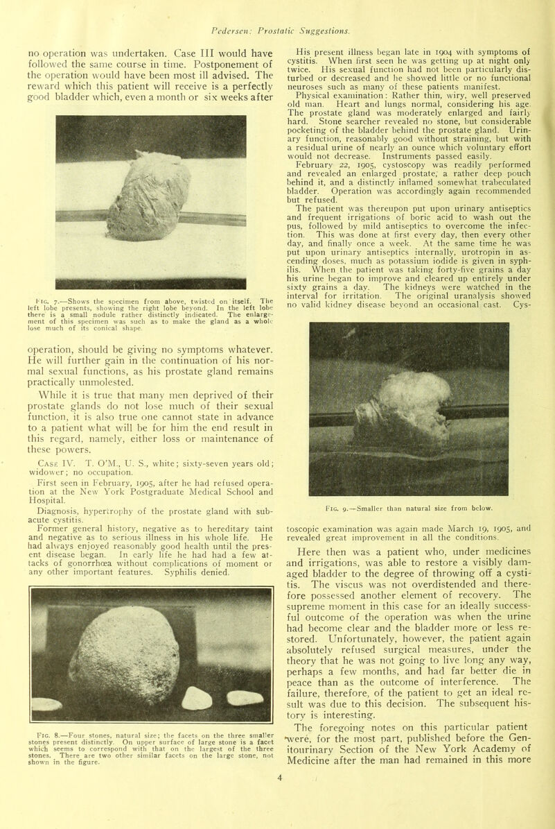 no operation was undertaken. Case III would have followed the same course in time. Postponement of the operation would have been most ill advised. The reward which this patient will receive is a perfectly good bladder which, even a month or six weeks after l*ig. 7.—Shows the specimen from above, twisted on itself. The left lobe presents, showing the right lobe beyond. In the left lobe there is a small nodule rather distinctly indicated. The enlarge- ment of this specimen was such as to make the gland as a whole lose much of its conical shape. operation, should be giving no symptoms whatever. He will further gain in the continuation of his nor- mal sexual functions, as his prostate gland remains practically unmolested. While it is true that many men deprived of their prostate glands do not lose much of their sexual function, it is also true one cannot state in advance to a patient what will be for him the end result in this regard, namely, either loss or maintenance of these powers. Case IV. T. O’M., U. S., white; sixty-seven years old; widower; no occupation. First seen in February, 1905, after he had refused opera- tion at the New York Postgraduate Medical School and Hospital. Diagnosis, hypertrophy of the prostate gland with sub- acute cystitis. Former general history, negative as to hereditary taint and negative as to serious illness in his whole life. He had always enjoyed reasonably good health until the pres- ent disease began. In early life he had had a few at- tacks of gonorrhoea without complications of moment or any other important features. Syphilis denied. Fig. 8.—Four stones, natural size; the facets on the three smaller stones present distinctly. On upper surface of large stone is a facet which seems to correspond with that on the largest of the three stones. There are two other similar facets on the large stone, not shown in the figure. His present illness began late in 1904 with symptoms of cystitis. When first seen he was getting up at night only twice. His sexual function had not been particularly dis- turbed or decreased and he showed little or no functional neuroses such as many of these patients manifest. Physical examination: Rather thin, wiry, well preserved old man. Heart and lungs normal, considering his age. The prostate gland was moderately enlarged and fairly hard. Stone searcher revealed no stone, but considerable pocketing of the bladder behind the prostate gland. Urin- ary function, reasonably good without straining, but with a residual urine of nearly an ounce which voluntary effort would not decrease. Instruments passed easily. February 22, 1905, cystoscopy was readily performed and revealed an enlarged prostate, a rather deep pouch behind it, and a distinctly inflamed somewhat trabeculated bladder. Operation was accordingly again recommended but refused. The patient was thereupon put upon urinary antiseptics and frequent irrigations of boric acid to wash out the pus, followed by mild antiseptics to overcome the infec- tion. This was done at first every day, then every other day, and finally once a week. At the same time he was put upon urinary antiseptics internally, urotropin in as- cending doses, much as potassium iodide is given in syph- ilis. When the patient was taking forty-five grains a day his urine began to improve and cleared up entirely under sixty grains a day. The kidneys were watched in the interval for irritation. The original uranalysis showed no valid kidney disease beyond an occasional cast. Cys- Fig. 9.—Smaller than natural size from below. toscopic examination was again made March 19, 1905, and revealed great improvement in all the conditions. Here then was a patient who, under medicines and irrigations, was able to restore a visibly dam- aged bladder to the degree of throwing off a cysti- tis. The viscus was not overdistended and there- fore possessed another element of recovery. The supreme moment in this case for an ideally success- ful outcome of the operation was when the urine had become clear and the bladder more or less re- stored. Unfortunately, however, the patient again absolutely refused surgical measures, under the theory that he was not going to live long any way, perhaps a few months, and had far better die in peace than as the outcome of interference. The failure, therefore, of the patient to get an ideal re- sult was due to this decision. The subsequent his- tory is interesting. The foregoing notes on this particular patient •were, for the most part, published before the Gen- itourinary Section of the New York Academy of Medicine after the man had remained in this more