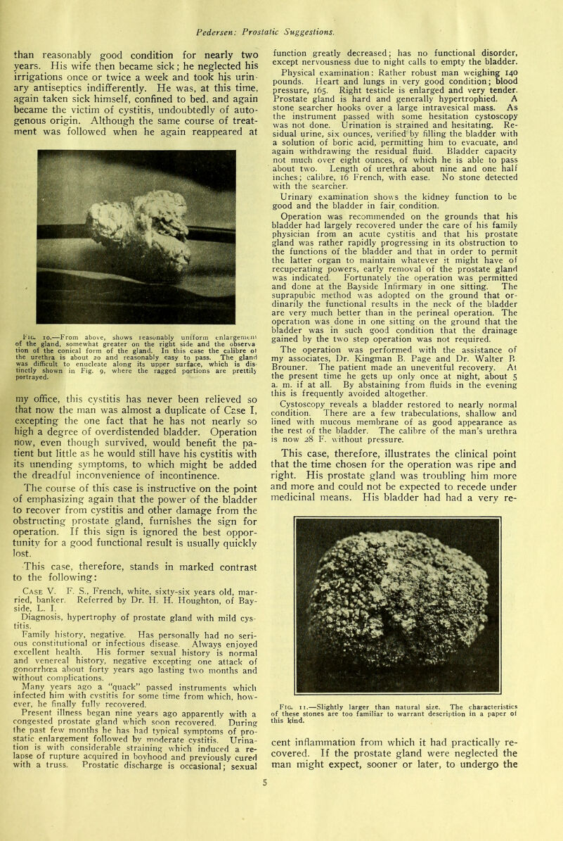 than reasonably good condition for nearly two years. His wife then became sick; he neglected his irrigations once or twice a week and took his urin- ary antiseptics indifferently. He was, at this time, again taken sick himself, confined to bed, and again became the victim of cystitis, undoubtedly of auto- genous origin. Although the same course of treat- ment was followed when he again reappeared at Fig. io.—From above, shows reasonably uniform enlargement of the gland, somewhat greater on the right side and the observa tion of the conical form of the gland. In this case the calibre ot the urethra is about 20 and reasonably easy to pass. The gland was difficult to enucleate along its upper surface, which is dis- tinctly shown in Fig. 9, where the ragged portions are prettily portrayed. my office, this cystitis has never been relieved so that now the man was almost a duplicate of Case I, excepting the one fact that he has not nearly so high a degree of overdistended bladder. Operation now, even though survived, would benefit the pa- tient but little as he would still have his cystitis with its unending symptoms, to which might be added the dreadful inconvenience of incontinence. The course of this case is instructive on the point of emphasizing again that the power of the bladder to recover from cystitis and other damage from the obstructing prostate gland, furnishes the sign for operation. If this sign is ignored the best oppor- tunity for a good functional result is usually quickly lost. This case, therefore, stands in marked contrast to the following: Case V. F. S., French, white, sixty-six years old, mar- ried, banker. Referred by Dr. H. H. Houghton, of Bay- side, L. I. Diagnosis, hypertrophy of prostate gland with mild cys- titis. Family history, negative. Has personally had no seri- ous constitutional or infectious disease. Always enjoyed excellent health. His former sexual history is normal and venereal history, negative excepting one attack of gonorrhoea about forty years ago lasting two months and without complications. Many years ago a “quack” passed instruments which infected him with cystitis for some time from which, how- ever, he finally fully recovered. Present illness began nine years ago apparently with a congested prostate gland which soon recovered. During Ihe past few months he has had typical symptoms of pro- static enlargement followed by moderate cvstitis. Urina- tion is with considerable straining which induced a re- lapse of rupture acquired in boyhood and previously cured with a truss. Prostatic discharge is occasional; sexual function greatly decreased; has no functional disorder, except nervousness due to night calls to empty the bladder. Physical examination: Rather robust man weighing 140 pounds. Heart and lungs in very good condition; blood pressure, 165. Right testicle is enlarged and very tender. Prostate gland is hard and generally hypertrophied. A stone searcher hooks over a large intravesical mass. As the instrument passed with some hesitation cystoscopy was not done. Urination is strained and hesitating. Re- sidual urine, six ounces, verified' by filling the bladder with a solution of boric acid, permitting him to evacuate, and again withdrawing the residual fluid. Bladder capacity not much over eight ounces, of which he is able to pass about two. Length of urethra about nine and one half inches; calibre, 16 French, with ease. No stone detected with the searcher. Urinary examination shows the kidney function to be good and the bladder in fair condition. Operation was recommended on the grounds that his bladder had largely recovered under the care of his family physician from an acute cystitis and that his prostate gland was rather rapidly progressing in its obstruction to the functions of the bladder and that in order to permit the latter organ to maintain whatever it might have of recuperating powers, early removal of the prostate gland was indicated. Fortunately the operation was permitted and done at the Bayside Infirmary in one sitting. The suprapubic method was adopted on the ground that or- dinarily the functional results in the neck of the bladder are very much better than in the perineal operation. The operation was done in one sitting on the ground that the bladder was in such good condition that the drainage gained by the tw'o step operation was not required. The operation was performed with the assistance of my associates, Dr. Kingman B. Page and Dr. Walter P. Brouner. The patient made an uneventful recovery. At the present time he gets up only once at night, about 5 a. m. if at all. By abstaining from fluids in the evening this is frequently avoided altogether. Cystoscopy reveals a bladder restored to nearly normal condition. There are a few trabeculations, shallow and lined with mucous membrane of as good appearance as the rest of the bladder. The calibre of the man’s urethra is now 28 F. without pressure. This case, therefore, illustrates the clinical point that the time chosen for the operation was ripe and right. His prostate gland was troubling him more and more and could not be expected to recede under medicinal means. His bladder had had a very re- Fig. 11.—Slightly larger than natural size. The characteristics of these stones are too familiar to warrant description in a paper of this kind. cent inflammation from which it had practically re- covered. If the prostate gland were neglected the man might expect, sooner or later, to undergo the