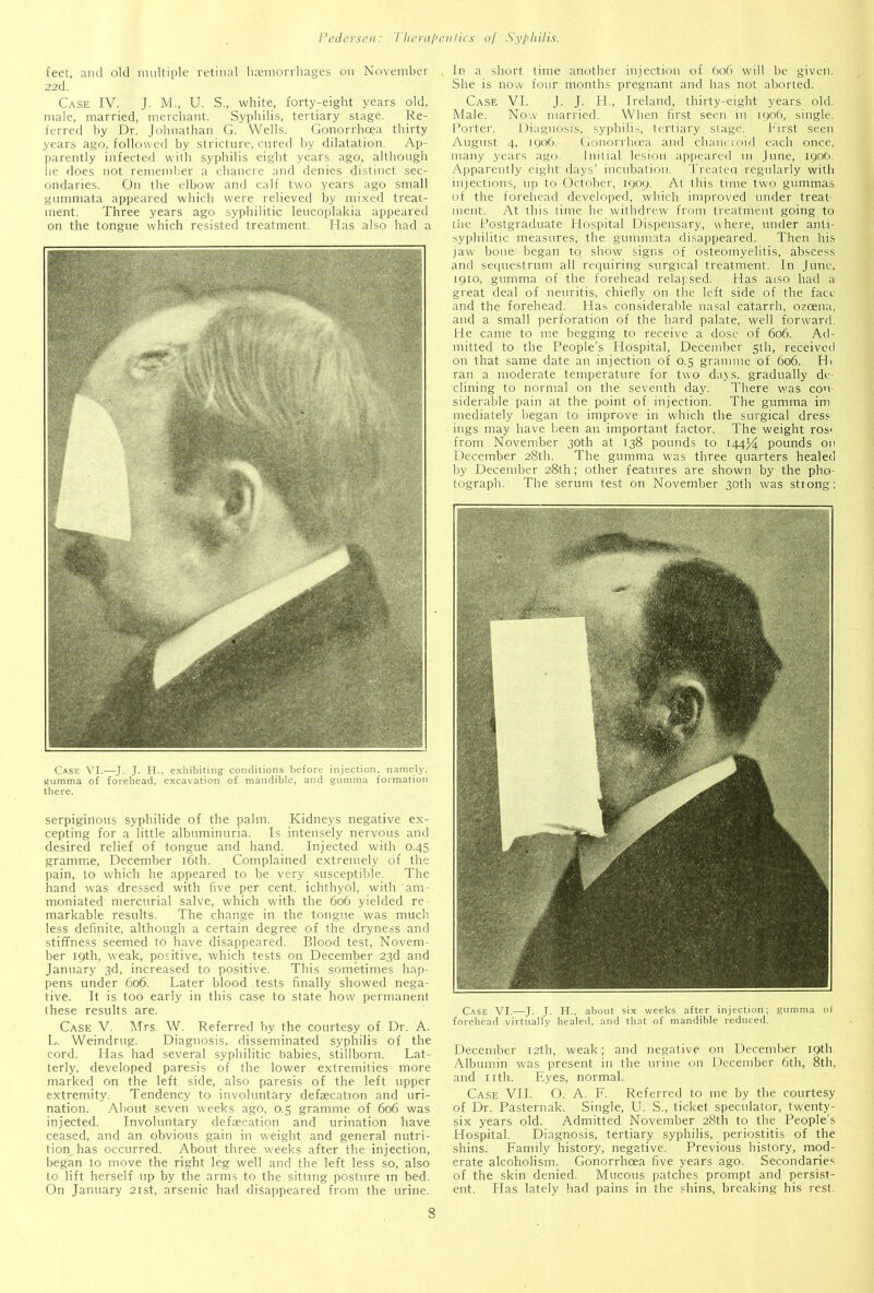 feet, and old multiple retinal haemorrhages on November 22d. Case IV. J. M., U. S., white, forty-eight years old, male, married, merchant. Syphilis, tertiary stage. Re- ferred by Dr. Johnathan G. Wells. Gonorrhoea thirty years ago, followed by stricture, cured by dilatation. Ap- parently infected with syphilis eight years ago, although lie does not remember a chancre and denies distinct sec- ondaries. On the elbow and calf two years ago small gummata appeared which were relieved by mixed treat- ment. Three years ago syphilitic leucoplakia appeared on the tongue which resisted treatment. Has also had a Case VI.—J. J. H., exhibiting conditions before injection, namely, gumma of forehead, excavation of mandible, and gumma formation there. serpiginous syphilide of the palm. Kidneys negative ex- cepting for a little albuminuria. Is intensely nervous and desired relief of tongue and hand. Injected with 0.45 gramme, December 16th. Complained extremely of the pain, to which he appeared to be very susceptible. The hand was dressed with five per cent, ichthyol, with am- moniated' mercurial salve, which with the 606 yielded re- markable results. The change in the tongue was much less definite, although a certain degree of the dryness and stiffness seemed to have disappeared. Blood test, Novem- ber 19th, weak, positive, which tests on December 23d and January 3d, increased to positive. This sometimes hap- pens under 606. Later blood tests finally showed nega- tive. It is too early in this case to state how permanent these results are. Case V. Mrs. W. Referred by the courtesy of Dr. A. L. Weindrug. Diagnosis, disseminated syphilis of the cord. Has had several syphilitic babies, stillborn. Lat- terly, developed paresis of the lower extremities more marked on the left side, also paresis of the left upper extremity. Tendency to involuntary defaecation and uri- nation. About seven weeks ago, 0.5 gramme of 606 was injected. Involuntary defecation and urination have ceased, and an obvious gain in weight and general nutri- tion has occurred. About three weeks after the injection, began to move the right leg well and the left less so, also to lift herself up by the arms to the sitting posture in bed. On January 21st, arsenic had disappeared from the urine. In a short time another injection of 606 will be given. She is now four months pregnant and has not aborted. Case VI. J. J. H., Ireland, thirty-eight years old. Male. Now married. When first seen in 1906, single. Porter. Diagnosis, syphilis, tertiary stage. First seen August 4, 1906. Gonorrhoea and chancroid each once, many years ago. Initial lesion appeared 111 June, 190b. Apparently eight days’ incubation. Treated regularly with injections, up to October, 1909. At this time two gummas of the forehead developed, which improved under treat ment. At this time he withdrew from treatment going to the Postgraduate Hospital Dispensary, where, under anti- syphilitic measures, the gummata disappeared. Then his jaw bone began to show signs of osteomyelitis, abscess and sequestrum all requiring surgical treatment. In June, 1910, gumma of the forehead relapsed. Has aiso had a great deal of neuritis, chiefly on the left side of the face and the forehead. Has considerable nasal catarrh, ozeena, and a small perforation of the hard palate, well forward. He came to me begging to receive a dose of 606. Ad- mitted to the People’s Hospital, December 5th, received on that same date an injection of 0.5 gramme of 606. Hi ran a moderate temperature for two days, gradually de- clining to normal on the seventh day. There was con- siderable pain at the point of injection. The gumma itn mediately began to improve in which the surgical dress ings may have been an important factor. The weight ros' from November 30th at 138 pounds to 144*4 pounds on December 28th. The gumma was three quarters healed by December 28th; other features are shown by the pho- tograph. The serum test on November 30th was strong; Case VI.—J. J. H.. about six weeks after injection; gumma of forehead virtually healed, and that of mandible reduced. December 12th, weak; and negative on December 19th Albumin was present in the urine on December 6th, 8th, and 11 th. Eyes, normal. Case VII. O. A. F. Referred to me by the courtesy of Dr. Pasternak. Single, U. S., ticket speculator, twenty- six years old. Admitted November 28th to the People's Hospital. Diagnosis, tertiary syphilis, periostitis of the shins. Family history, negative. Previous history, mod- erate alcoholism. Gonorrhoea five years ago. Secondaries of the skin denied. Mucous patches prompt and persist- ent. Has lately had pains in the shins, breaking his rest.