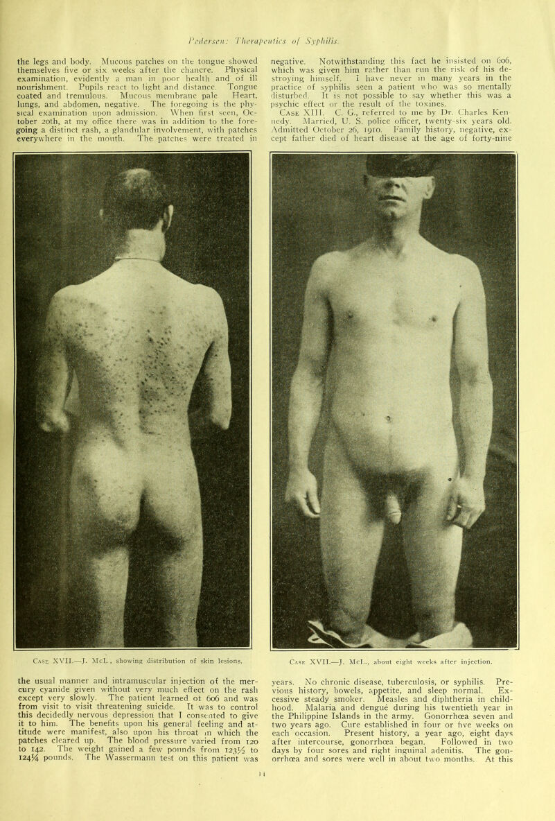 the legs and body. Mucous patches on the tongue showed themselves five or six weeks after the chancre. Physical examination, evidently a man in poor health and of ill nourishment. Pupils react to light and distance. Tongue coated and tremulous. Mucous membrane pale Heart, lungs, and abdomen, negative. The foregoing is the phy- sical examination upon admission. When first seen, Oc- tober 20th, at my office there was in addition to the fore- going a distinct rash, a glandular involvement, with patches everywhere in the mouth. The patches were treated in Case XVII.—J. McL , showing distribution of skin lesions. negative. Notwithstanding this fact he insisted on 606, which was given him rather than run the risk of his de- stroying himself. I have never in many years in the practice of syphilis seen a patient who was so mentally disturbed. It is not possible to say whether this was a psychic effect or the result of the toxines. Case XIII. C. G., referred to me by Dr. Charles Ken nedy. Married, U. S. police officer, twenty-six years old. Admitted October 26, 1910. Family history, negative, ex- cept father died of heart disease at the age of forty-nine Case XVII.—J. McL., about eight weeks after injection. the usual manner and intramuscular injection of the mer- cury cyanide given without very much effect on the rash except very slowly. The patient learned ot 606 and was from visit to visit threatening suicide. It was to control this decidedly nervous depression that I consented to give it to him. The benefits upon his general feeling and at- titude were manifest, also upon his throat in which the patches cleared up. The blood pressure varied from 120 to 142. The weight gained a few pounds from. 12334 to 12434 pounds. The Wassermann test on this patient was years. No chronic disease, tuberculosis, or syphilis. Pre- vious history, bowels, appetite, and sleep normal. Ex- cessive steady smoker. Measles and diphtheria in child- hood. Malaria and dengue during his twentieth year in the Philippine Islands in the army. Gonorrhoea seven and two years ago. Cure established in four or five weeks on each occasion. Present history, a year ago, eight days after intercourse, gonorrhoea began. Followed in two days by four sores and right inguinal adenitis. The gon- orrhoea and sores were well in about two months. At this