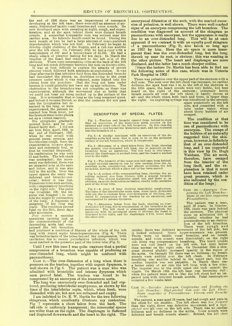 the end of 1906 there was an impairment of resonance developing at the left base; there were still an absence of air- entry, diminished tactile vocal fremitus and voice sounds. He now developed pain with sweating at night, cough, and expec- toration, and at the apex behind there were distant breath sounds. A somewhat tympanitic note was noticed near the cardiac area. No tubercle bacilli could be found. Daring the next month or two he had a large amount of muco purulent expectoration which was not foul. In February he began to develop slight clubbing of the fingers, and a rub was audible over the left chest. On February 27th he had a rigor with a temperature of 105° and a leucocytosis of 33,700. He had a sharp attack of pleurisy lasting for ten days. In March the impulse of the heart had returned to the left sile of the sternum. There were consonating rales at the back of the left lung and not much difference between the note on the two sides. It was at first difficult to explain the attacks of severe pleurisy which followed both attempts at exploration. It was clear afterwards that infective fluid from the distended bronchi had inoculated the pleura, as, doubtless owing to the great pressure under which it was retained, some leaked into the pleura from the puncture Had the lung not been under tension it would probably not have set up any infection. The obstruction to the bronchus was not complete, as there was expectoration, although the movement was so feeble that we could not hear air being sucked up to the surface of the lung. It is noticeable that so long as the lung remained quiet, and before it became fibroid, so that the contents did not pass into the lymphatics but re- mained in the lung, or were expectorated, the patient re- mained free from fever, yet the faintest trace in the pleura set up a violent reaction. His symptoms gradually quieted down, and he con- tinued fairly well. I did not see him from April, 1906, to the end of February, 1907, when he was seized with general pains, pyrexia, and troublesome cough. Soon the expectoration became abun- dant and extremely foul, so that he vomited frequently. On readmission he was very ill and feeble. The left chest was contracted; the move- ment was deficient, there was an impaired note at the apex and below, and it was also dull in the axilla. Over the upper spaces the entry was deficient and broncho-vesi- cular ; below it was lost. Numerous rales were audible, with compensatory breathing on the right side. The pulse was irregular, 108; the im- pulse was dragged 1 in. out- side the nipple by contraction of the lung. A diagnosis of gangrene of the lung was made. The condition proved fatal on the 26th, three days after admission. Post mortem a saccular aneurysm opening just at the commencement of the descending aorta had com- pressed the left bronchus and produced a condition of fibrosis of the whole of the left lung with recent septic bronchopneumonia (Fig. 4). There was bronchiectasis of the tubes beyond the compression, with cavitation due to recent putrefactive infection, which was most marked in the posterior part of the lower lobe (Fig. 5). Until I saw this case I was quite unaware that a partial compression of a bronchus was capable of producing an over-distended lung, which might be confused with pneumothorax. Case ii.—The over-distension of a lung when there is pressure on the trachea, together with urgent dyspnoea, is well shown in Fig. 6. The patient was a man who was admitted with bronchitis and intense dyspnoea which soon proved fatal. The trachea was found to be compressed by an aneurysm of the transverse aorta. The lung was enormously over-distended and had rup- tured, producing interlobular emphysema, as shown by the lines of the interlobular septa, which, when fresh, were distended with air, but now are collapsed and empty. I am indebted to Dr. E. W. Martin for the two following skiagrams, which excellently illustrate my contention. Fig. 7 represents a chest taken from the back. The left side is uniformly transparent; the intercostal spaces are wider than on the right. The diaphragm is flattened and displaced downwards and the heart to the right. The aneurysmal dilatation of the arch, with the marked excur- sion of pulsation, is well shown. There were well-marked signs of an aneurysm compressing the left bronchus. The condition was diagnosed on account of the skiagram as pneumothorax with aneurysm, but the appearance is really due to an over-distended lung. This will be at once apparent if we contrast it with an equally good skiagram of a pneumothorax (Fig. 8), also taken so long ago as 1902 by him. Here the air space is more trans- parent than was the over-distended lung, but the lung, shrunk up near its root, is obvious; this was wanting in the other picture. The heart and diaphragm are more displaced, and the latter has a much sharper outline. [Since the lecture Dr. Martin has been able to find me the following notes of this case, which was in Victoria Park Hospital in 1902 : There was pulsation over the upper part of the sternum with a dull note. The note over the left chest was resonant, no cardiac dullness, the apex beat was 1 in. to the left of the sternum in the fifth space, the heart sounds were very feeble, but best heard on the right of the sternum; extremely feeble breath sounds all over the left chest—it hardly moves at all—and the whole chest, both hack and front, is larger than the right. An exploring syringe was introduced in the seventh space posteriorly on the left side, and connected with a tube under water, when about thirty bubbles of air escaped. The condition at that time was considered to be one of pneumothorax with aneurysm. The escape of the bubbles of air naturally suggested this; the skia- gram, however, is definitely that of an over distended lung, and I am supported in this view by Dr. Hugh Walsham. The air must, therefore, have escaped from the interior of the lung itself, and the ex- planation is that it must have been retained under great pressure, which is also indicated by the con- dition of the lungs.] Case hi.—Aneurysm Com- pressing the Left Bronchus : Signs at one time suggesting Pneumothorax. The patient was a man, aged 39 years. In October, 1906, there was pain behind the sternum. The physical signs on admission left it doubtful whether he had pneumothorax or an obstruc- tion of the left bronchus. There were cough and stridor, there was deficient movement of the left side, but it looked enlarged. Some hyper-resonance was present. There were no tactile vocal fremitus, and no breath sounds, and voice sounds were diminished; on the right side there was compensatory breathing. The heart sounds were not well heard on the left side, but were better than normal on the right side. On December 15th a skia- gram showed slightly increased opacity in the region of the aorta. On January 7th there was no dullness; no breath sounds were audible over the left chest. In February breathing was audible behind in the upper part, but the cardiac impulse was not palpable. In March there was a better entry of air into the left lung, with a few rales. The impulse was in the sixth space one inch outside the nipple. On March 14th the left base was becoming dull ; when the patient went out in May the left chest had an im- paired note with deficient breath sounds. Fatal haemoptysis occurred a few weeks later. 'Case iv.—Saccular Aneurysm Compressing and Eroding the Left Bronchus: High-pitched Bote over the Left Chest: Signs suggestive of Pneumothorax: Fibrosis with Bronchi- ectasis. The patient, a man aged 38 years, had had cough and pain in the chest for six months. The left chest was less flattened than the right, there was defective movement, and a high- pitched note all over on the left side. There was no cardiac dullness and no dullness in the axilla. Voice sounds were deficient and breath sounds absent. Behind, the left chest DESCRIPTION OF SPECIAL PLATES. Fig. 1.—Trachea and bronchi opened from behind to show that an aneurysm of the transverse aorta presses on the anterior and outer side of the left bronchus. In this case the aneurysm is just beyond the transverse part, and has ruptured into the bronchus at A. Fig. 2.—A similar specimen with an aneurysm of the de- scending aorta laid open; this is seen to lie on the posterior surface of the left bronchus, which it compresses. Fig. 3.—Skiagram of a chest taken from the front, showing the greatly over-distended left lung, due to pressure on the bronchus from an aneurysm. The left lung is over-trans- parent. the diaphragm is pushed down, and the heart is pushed over to the right. Fig 4.—The bronchi of the same case laid open from behind. A small saccular aneurysm can be seen opening from the de- scending aorta, compressing, and almost occluding, the left bronchus, through which a glass rod (a) has been passed. Fig. 5.—A section of the corresponding lung, showing the re- sulting reduced size from fibrosis, with a general bronchi- ectasis. The fibrous trabeculae stand out, and there is, in addition, an acute destructive cavitation, chiefly in the posterior part of the lower lobe. Fig. 6.—A piece of lung showing interstitial emphysema. The lines of the interlobular septa were, when fresh, distended with air, due to rupture from over-distension of the lung, pro- duced by compression of the trachea by an aneurysm, and accompanied by intense dyspnoea. Fig. 7.—Skiagram taken from the back, showing an over- distended left lung, due to compression of the bronchus by an aneurysm The left chest is abnormally transparent, the aneurysm with its movement above is obvious, the heart is displaced to the right, and the diaphragm is 2 in. lower than the other side.