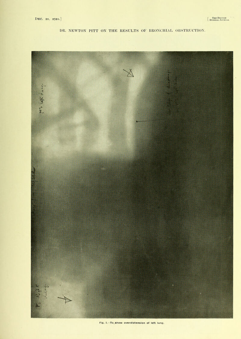 DR. NEWTON PITT ON THE RESULTS OF BRONCHIAL OBSTRUCTION. Fig. 3.—To_show overdistension of left lung.