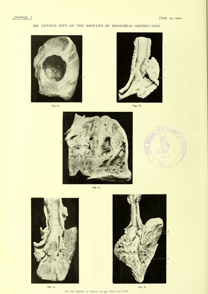 Medical Journal ] [Dec ip, igio. DR. NEWTON PITT ON THE RESULTS OF BRONCHIAL OBSTRUCTION. Fig. 10. Fig. 12.