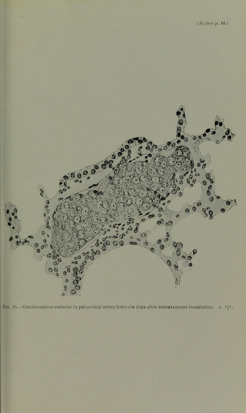 Fig. 15.—Carcinomatous embolus in pulmonary artery forty-six days after subcutaneous inoculation, x 4 II (» 1 *