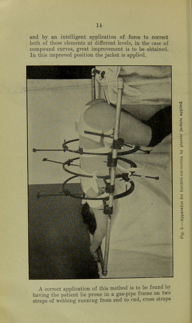 11 and by an intelligent application of force to correct both of these elements at different levels, in the case of compound curves, great improvement is to be obtained. In this improved position the jacket is applied. A correct application of this method is to be found by having the patient lie prone in a gas-pipe frame on two straps of webbing running from end to end, cross straps Apparatus for forcible correction by plaster jackets applied.