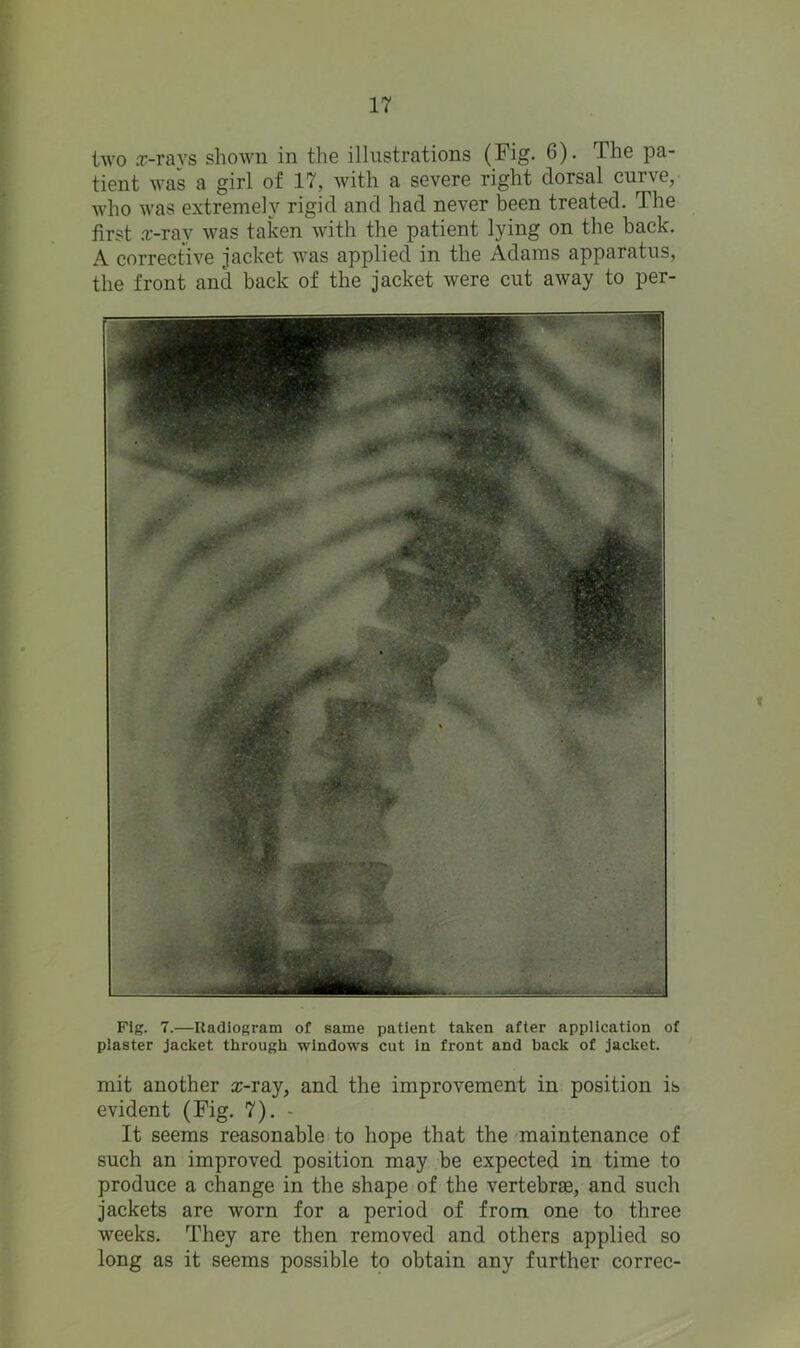 two x-rays shown in the illustrations (Fig. 6). The pa- tient was a girl of 17, with a severe right dorsal cuive, who was extremely rigid and had never been treated. The first x-ray was taken with the patient lying on the back. A corrective jacket was applied in the Adams apparatus, the front and back of the jacket were cut away to per- i Fig. 7.—Radiogram of same patient taken after application of plaster jacket through windows cut in front and back of jacket. mit another x-ray, and the improvement in position is evident (Fig. 7). - It seems reasonable to hope that the maintenance of such an improved position may be expected in time to produce a change in the shape of the vertebrae, and such jackets are worn for a period of from one to three weeks. They are then removed and others applied so long as it seems possible to obtain any further correc-