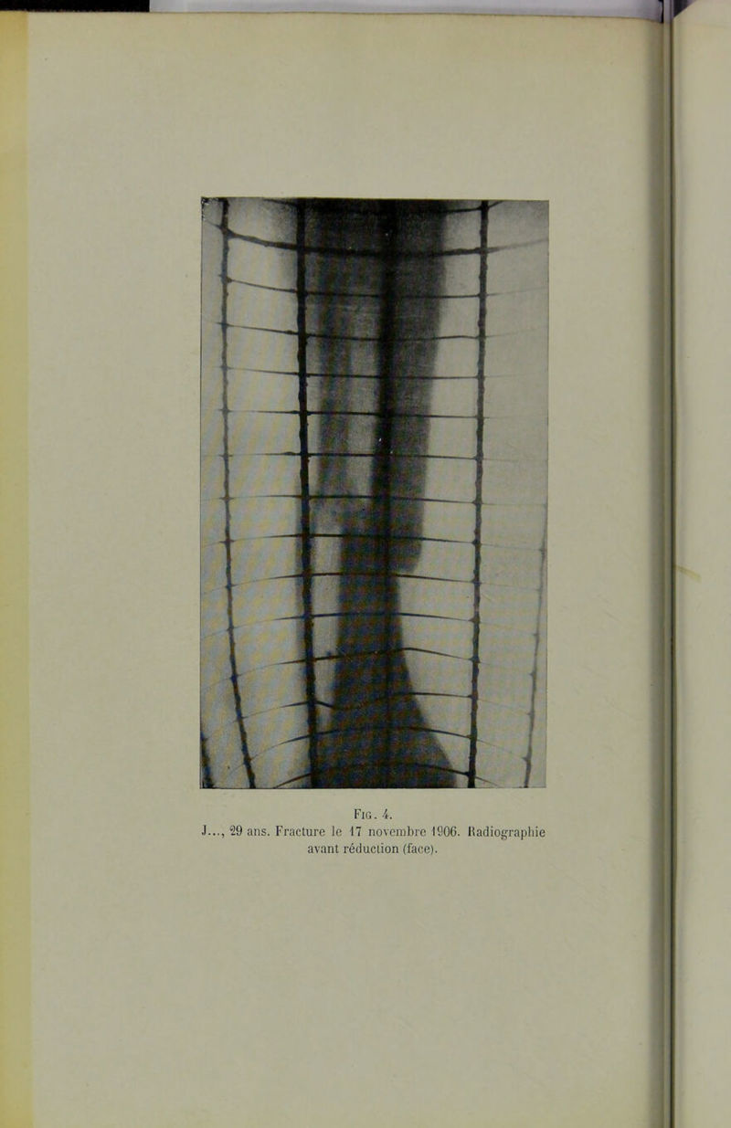 J..., 29 ans. Fracture le 17 novembre 1906. Radiographie avant réduction (face).