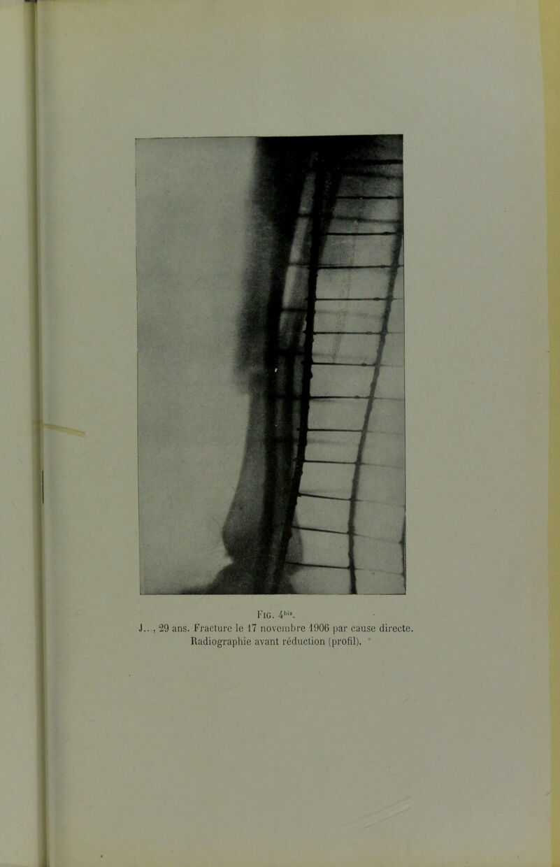 J..., 29 ans. Fracture le 17 novembre 1906 par cause directe. Radiographie avant réduction (profil).