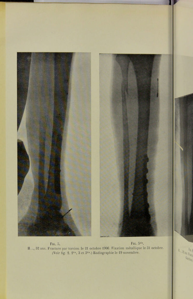 I ’ II..., 33 ans. Fracture par torsion le 21 octobre IflOG. Fixation métallique le 31 octobre. I\(j