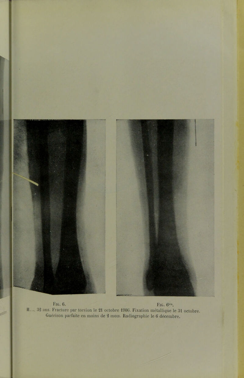 32 ;ins. Fracture par torsion le 21 octobre 190U. Fixation métallique le 31 octobre. Guérison parfaite en moins de 2 mois. Radiographie le 6 décembre.