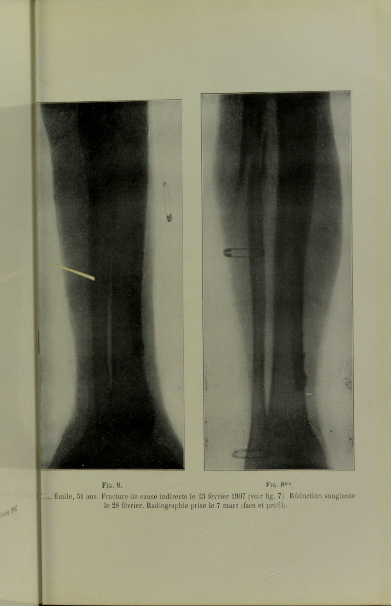 Fig. 8. Fig. 8'. Émile, 51 ans. Fracture de cause indirecte le 23 février 1Ü07 (voir fig. 7). Réduction sanglante