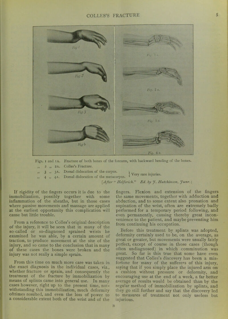 Figs. I and ia. Fracture of both bones of the forearm, with bade ward bending of the bones. ,, 2 „ 2A. Colles’s Fracture. „ r ,, ?A. Dorsal dislocation of the carpus. \ _ .... . . , > Very rare injuries. ,, 4 „ 4A. Dorsal dislocation of the metacarpus. 1 [After “ Helferich. Ed. by J. Hutchinson, Junr. \ If rigidity of the fingers occurs it is due to the immobilization, possibly together with some inflammation of the sheaths, but in those cases where passive movements and massage are applied at the earliest opportunity this complication will cause but little trouble. From a reference to Colles’s original description of the injury, it will be seen that in many of the so-called or so-diagnosed sprained wrists he examined he was able, by a certain amount of traction, to produce movement at the site of the injury, and so came to the conclusion that in many of these cases the bones were broken and the injur)' was not really a simple sprain. From this time on much more care was taken in the exact diagnosis in the individual cases, viz., whether fracture or sprain, and consequently the treatment of the fracture by immobilization by means of splints came into general use. In many cases however, right up to the present time, not- withstanding this immobilization, much deformity ofttimes resulted, and even the loss of power to a considerable extent both of the wrist and of the fingers. Flexion and extension of the fingers the same movements, together with adduction and abduction, and to some extent also pronation and supination of the wrist, often are extremely badly performed for a temporary period following, and even permanently, causing thereby great incon- venience to the patient, and maybe preventing him from continuing his occupation. Before this treatment by splints was adopted, deformity certainly used to be, on the average, as great or greater, but movements were usually fairly perfect, except of course in those cases (though often undiagnosed) in which comminution was great. So far is this true that some have even suggested that Colles’s discovery has been a mis- fortune for many of the sufferers of this injury, saying that if you simply place the injured arm on a cushion without pressure or deformity, and encouraging use at the end of a week, a far better average of results would be obtained than by the regular method of immobilization by splints, and they go still further and say that the discovery led to measures of treatment not only useless but injurious. B