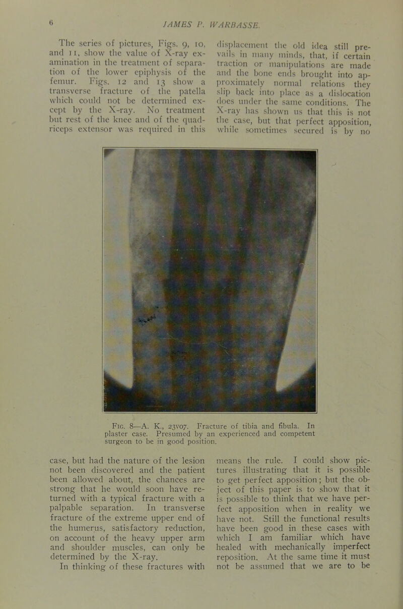 G Tlie scries of pictures, Figs. 9, 10, and ] I, show the value of X-ray ex- amination in the treatment of separa- tion of the lower epiphysis of the femur. Figs. 12 ami 13 show a transverse fracture of the patella which could not be determined ex- cept by the X-ray. No treatment but rest of the knee and of the quad- riceps extensor was required in this case, but had the nature of the lesion not been discovered and the patient been allowed about, the chances are strong that he would soon have re- turned with a typical fracture with a palpable separation. In transverse fracture of the extreme upper end of the humerus, satisfactory reduction, on account of the heavy upper arm and shoulder muscles, can only be determined by the X-ray. In thinking of these fractures with displacement the old idea still pre- vails in many minds, that, if certain traction or manipulations are made and the bone ends brought into ap- proximately normal relations they slip back into place as a dislocation docs under the same conditions. The X-ray has shown us that this is not the case, but that perfect apposition, while sometimes secured is by no means the rule. I could show pic- tures illustrating that it is possible to get perfect apposition; but the ob- ject of this paper is to show that it is possible to think that we have per- fect apposition when in reality we have not. Still the functional results have been good in these cases with which I am familiar which have healed with mechanically imperfect reposition. At the same time it must not be assumed that we are to be Fig. 8—A. K., 23V07. Fracture of tibia and fibula. In plaster case. Presumed by an experienced and competent surgeon to be in good position.