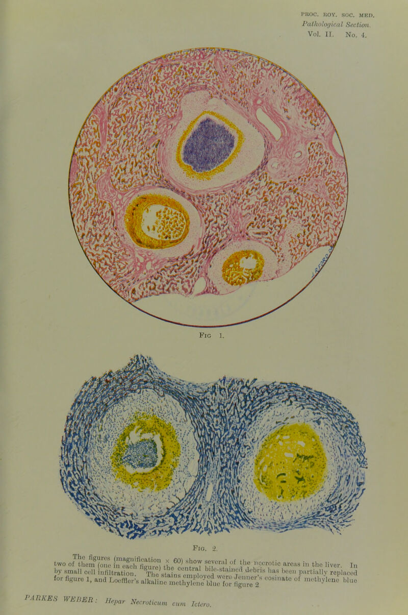 I’llOC. UOY. SOC. MKI). Palholoflical Section. Vo). 11. No. 4. two or.u.Sfp„ S? ■ i ).V small cell infiltration. Tim stains omifiov^e^^ replaced for figure 1. and Loefiler-s alkafi.mTrtb;^^^ '»»o I’ARKES WEBER: llepar Necroticum cum Ictero.