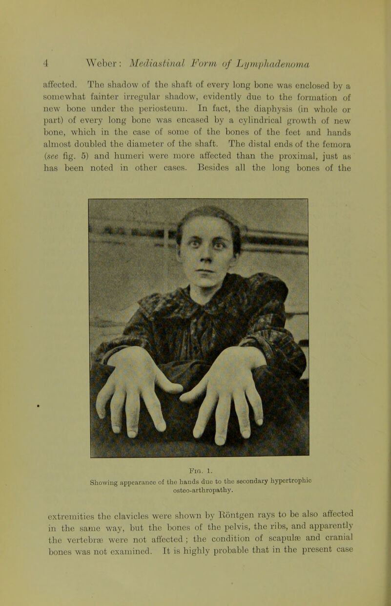 affected. The shadow of the shaft of every long bone was enclosed by a somewhat fainter irregular shadow, evidently due to the formation of new bone under the periosteum, fn fact, the diaphysis (in whole or part) of every long bone was encased by a cylindrical growth of new bone, which in the case of some of the bones of the feet and hands almost doubled the diameter of the shaft. The distal ends of the femora {see fig. 5) and humeri were more affected than the proximal, just as has been noted in other cases. Besides all the long bones of the Pig. 1. Showing appearance of the hands due to the secondary hypertrophic osteo-arthropathy. extremities the clavicles were shown by Rontgen rays to be also affected in the same way, but the bones of the pelvis, the ribs, and apparently the vertebrae were not affected ; the condition of scapulae and cranial bones was not examined. It is highly probable that in the present case