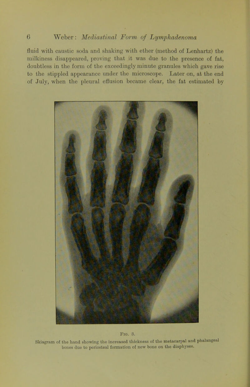 fluid with caustic soda and shaking with ether (method of Lenhartz) the milkiness disappeared, proving that it was due to the presence of fat, doubtless in the form of the exceedingly minute granules which gave rise to the stippled appearance under the microscope. Later on, at the end of July, when the pleural effusion became clear, the fat estimated by Fig. 3. Skiagram of the hand showing tho increased thickness of the metacarpal and phalangeal bones duo to periosteal formation of new bone on the diaphyses.
