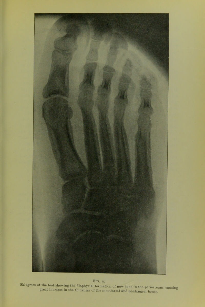 Fig. 4. Skiagram of the foot showing the diaphysial formation of new bone in the periosteum, causing great increase in the thickness of the metatarsal and phalangeal bones.