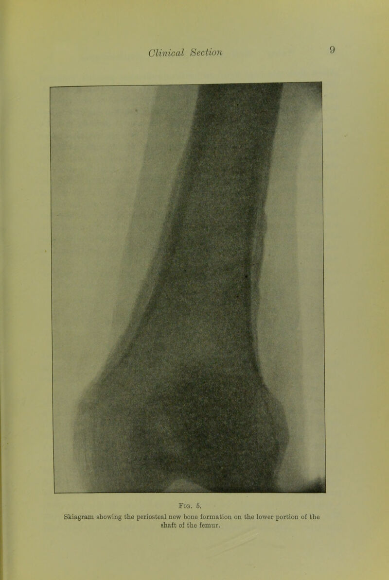 Fig. 5. Skiagram showing the periosteal now bone formation on tho lower portion of the shaft of tho femur.