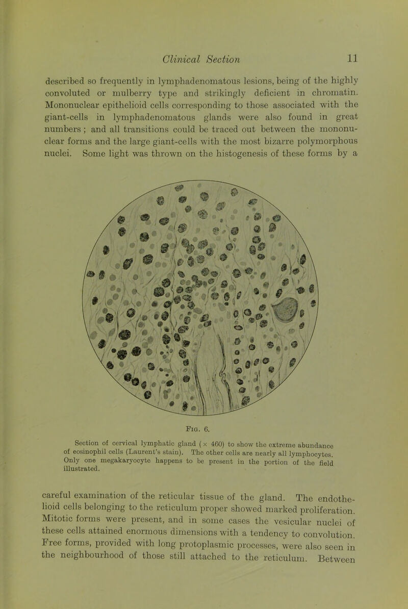 described so frequently in lymphadenomatous lesions, being of the highly convoluted or mulberry type and strikingly deficient in chromatin. Mononuclear epithelioid cells corresponding to those associated with the giant-cells in lymphadenomatous glands were also found in great numbers ; and all transitions could be traced out between the mononu- clear forms and the large giant-cells with the most bizarre polymorphous nuclei. Some light was thrown on the histogenesis of these forms by a Pig. 6. Section of cervical lymphatic gland (x 460) to show the extreme abundance of eosinophil cells (Laurent’s stain). The other cells are nearly all lymphocytes. Only one megakaryocyte happens to be present in the portion of the field illustrated. careful examination of the reticular tissue of the gland. The endothe- lioid cells belonging to the reticulum proper showed marked proliferation. Mitotic forms were present, and in some cases the vesicular nuclei of these cells attained enormous dimensions with a tendency to convolution. Free forms, provided with long protoplasmic processes, were also seen in the neighbouihood of those still attached to the reticulum. Between