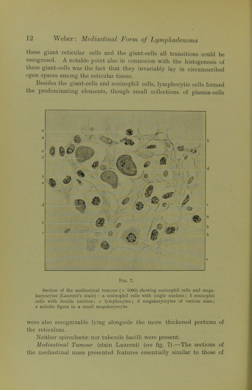 these giant reticular cells and the giant-cells all transitions could be recognised. A notable point also in connexion with the histogenesis of these giant-cells was the fact that they invariably lay in circumscribed open spaces among the reticular tissue. Besides the giant-cells and eosinophil cells, lymphocytic cells formed the predominating elements, though small collections of plasma-cells Fig. 7. Section of the mediastinal tumour (x 1000) showing eosinophil cells and mega- karyocytes (Laurent’s stain) : a eosinophil cells with single nucleus; b eosinophil cells with double nucleus; c lymphocytes; d megakaryocytes of various sizes; e mitotic figure in a small megakarj'ocyte. were also recognizable lying alongside the more thickened portions of the reticulum. Neither spirochsctoe nor tubercle bacilli were present. Mediastinal Tumour (stain Laurent) {see fig. 7).—The sections of the mediastinal mass presented features essentially similar to those of