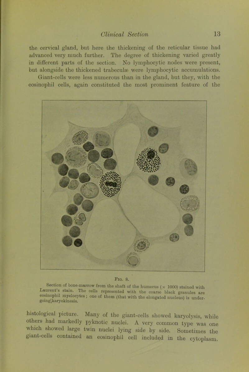 the cervical gland, but here the thickening of the reticular tissue had advanced very much further. The degree of thickening varied greatly in different parts of the section. No lymphocytic nodes were present, but alongside the thickened trabeculae were lymphocytic accumulations. Giant-cells were less numerous than in the gland, but they, with the eosinophil cells, again constituted the most prominent feature of the Section of bone-marrow from the shaft of the humerus (x 1000) stained with Laurent’s stain. The cells represented with the coarse black granules are eosinopbil myelocytes ; one of them (that with the elongated nucleus) is under- going jkaryokinesis. histological picture. Many of the giant-cells showed karyolysis, while others had markedly pyknotic nuclei. A very common type was one which showed large twin nuclei lying side by side. Sometimes the giant-cells contained an eosinophil cell included in the cytoplasm.