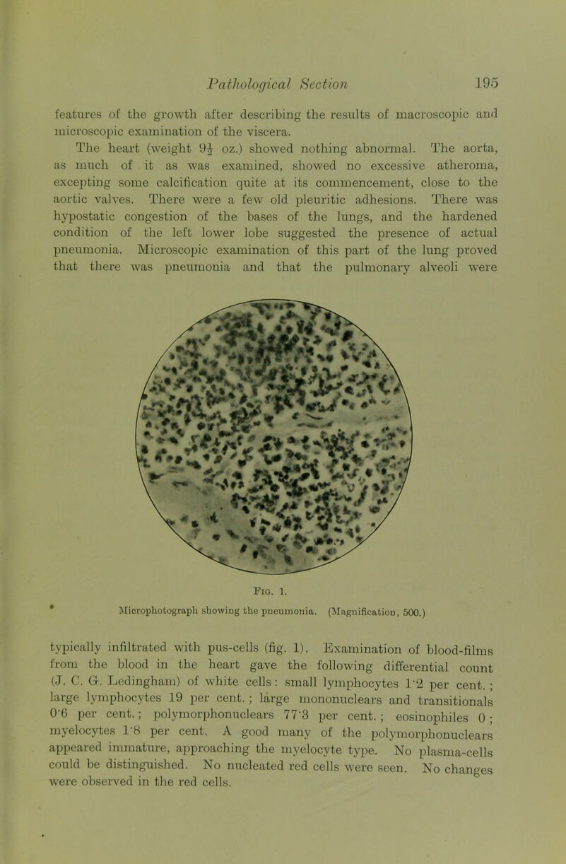features of the growth after describing the results of macroscopic and microscopic examination of the viscera. The heart (weight 9^ oz.) showed nothing abnormal. The aorta, as much of it as was examined, showed no excessive atheroma, excepting some calcification quite at its commencement, close to the aortic valves. There were a few old pleuritic adhesions. There was hypostatic congestion of the bases of the lungs, and the hardened condition of the left lower lobe suggested the presence of actual pneumonia. Microscopic examination of this part of the lung proved that there was pneumonia and that the pulmonary alveoli were Fig. i. Microphotograph showing the pneumonia. (Magnification, 500.) typically infiltrated with pus-cells (fig. 1). Examination of blood-films from the blood in the heart gave the following differential count (J. C. G. Ledingham) of white cells: small lymphocytes T2 per cent. ; large lymphocytes 19 per cent. ; large mononuclears and transitionals 0'6 per cent.; polymorphonuclears 77’3 per cent. ; eosinophiles 0 ; myelocytes T8 per cent. A good many of the polymorphonuclears appeared immature, approaching the myelocyte type. No plasma-cells could be distinguished. No nucleated red cells were seen. No changes were observed in the red cells.
