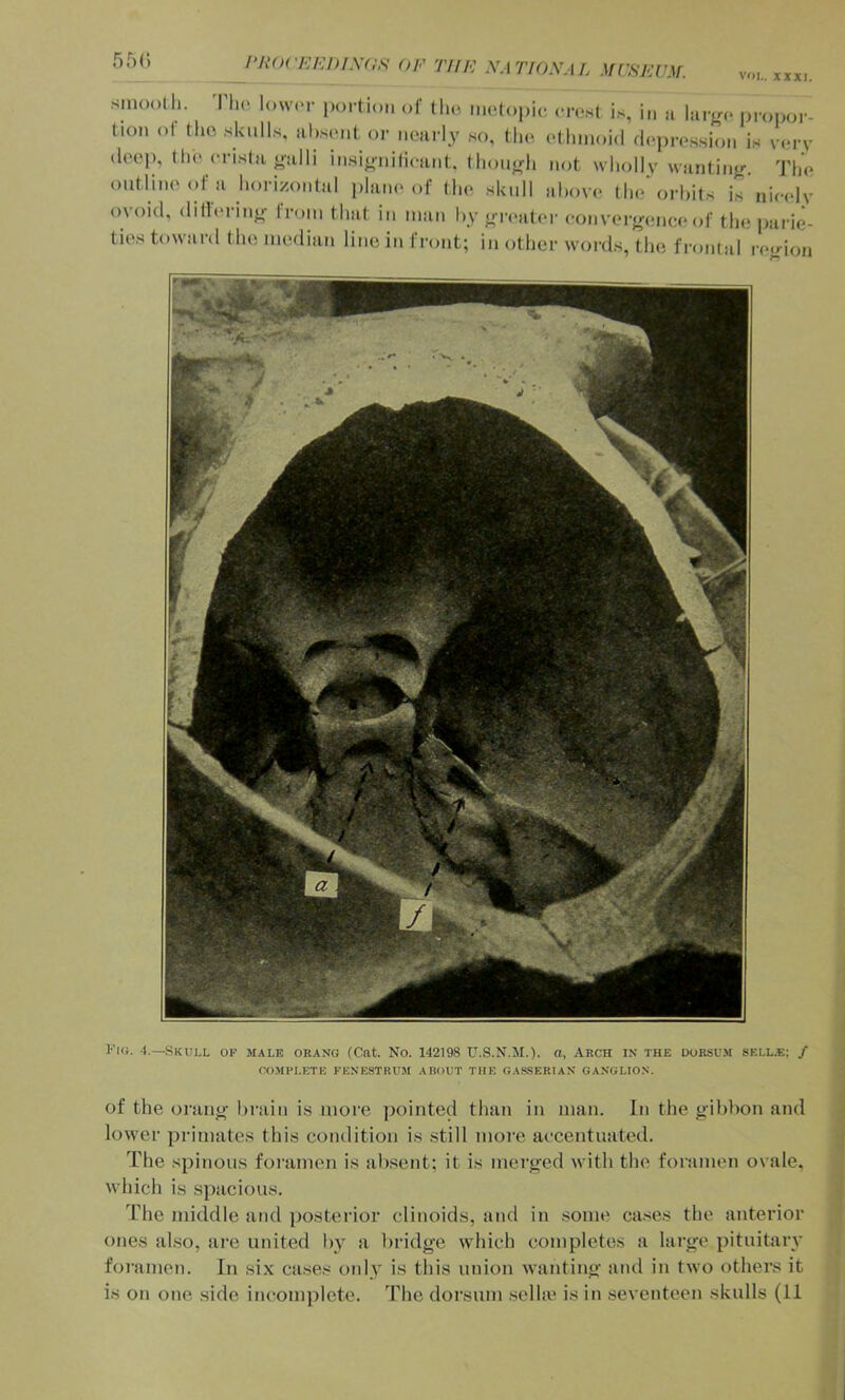 5r)C) l‘R()('Ei:i)IXas OF THE .V.17'/0.V.I/. .\f[’SE[’M. VOL. XXXI. smooth. T1h> lower portion of (h.>, metopi,, (-rest i.s, i„ a larj^e propor- tion of Mio skulls, absent or nearly .so, the ethmoid deiire.ssion is verv deep, till'crista ealli insienilicniit. thoii<(h not whollv wantiiifr. The outline of a horizontal plain'of the skull above the\u-bits is nieelv ovoid, diflerine- from that in man by e-n'ati'r eonverf^imce of the parie- ties toward the median lino in front; in other word.s, the frontal re.rion Kicj. -1.—Skull of male orang (Cat. No. 142198 U.S.N.M.). a, Arch in the dorsum sell.e; / COMPLETE FENESTRUM ABOUT THE GAS.SERIAN GANGLION. of the oranj>- brain is more pointed than in man. In the gibbon and lower primate.s this condition is still more ac-centuated. The spinous foramen is absent; it is merged with the foramen ovale, which i.s spacious. The middle and ])osterior clinoids, and in some ca.ses the anterior ones also, are united by a bridge which completes a large pituitary foramen. In six cases only is this union wanting and in two othei’s it is on one side incomplete. The dorsum .selhe is in .seventeen skulls (11