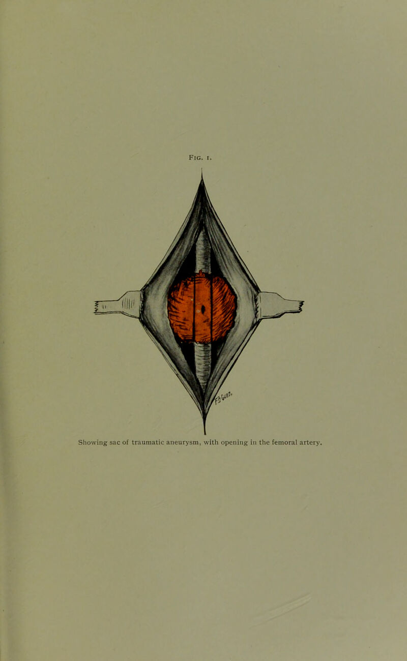 Showing sac of traumatic aneurysm, with opening in the femoral artery.