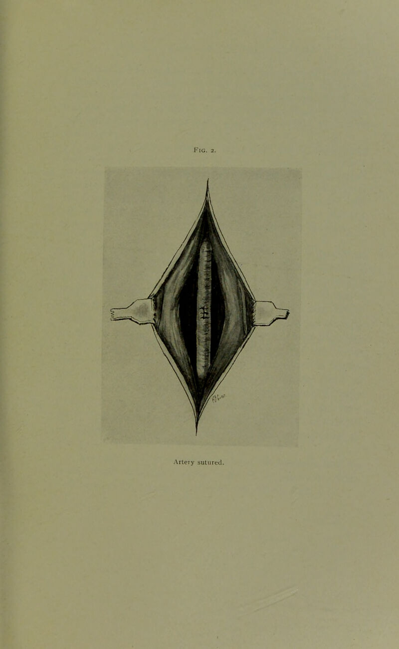 Arteiy sutured.