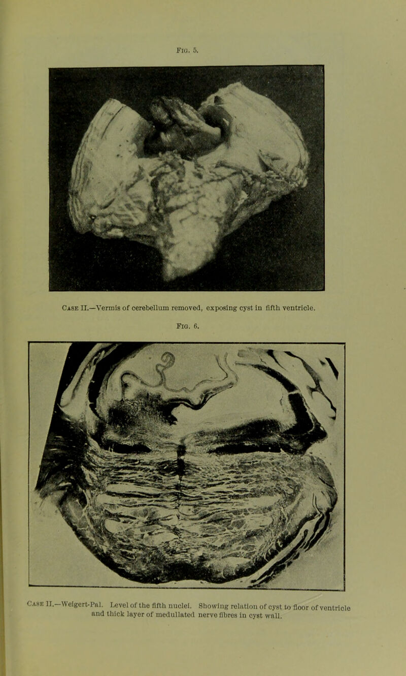 Case II.—Vermis of cerebellum removed, exposing cyst in fifth ventricle. Fig. 6. Case II.—Weigert-Pal. Level of the fifth nuclei. Showing relation of cyst to floor of ventricle and thick layer of medullated nerve fibres in cyst wall.