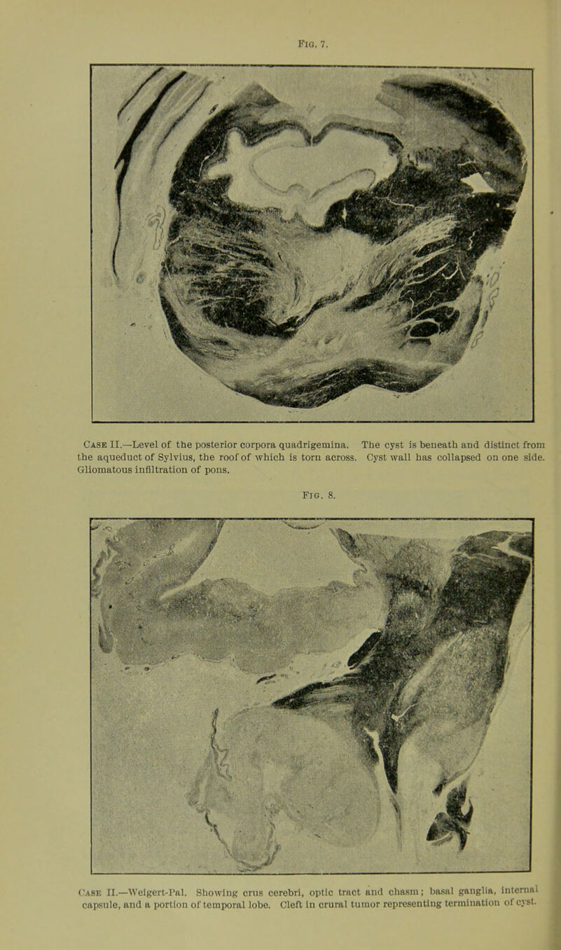 Case II.—Level of the posterior corpora quadrigemina. The cyst is beneath and distinct from the aqueduct of Sylvius, the roof of which is torn across. Cyst wall has collapsed on one side. Gliomatous infiltration of pons. Fig. 8. Case II.—Weigert-Pal. Showing crus cerebri, optic tract and chasm; basal ganglia, internal capsule, and a portion of temporal lobe. Cleft in crural tumor representing termination of cyst.