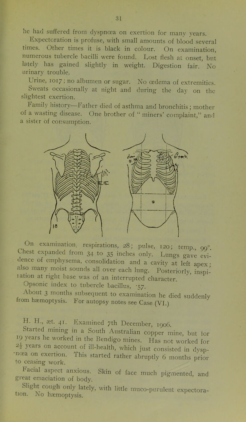 iic had suffered from dyspnoea on exertion for many years. Expectoration is profuse, with small amounts of blood several times. Other times it is black in colour. On examination, numerous tubercle bacilli were found. Lost flesh at onset, but lately has gained slightly in weight. Digestion fair. No urinary trouble. Urine, 1017; no albumen or sugar. No oedema of extremities. Sweats occasionally at night and during the da}’ on the slightest exertion. Family history—Father died of asthma and bronchitis; mother of a wasting disease. One brother of “ miners’ complaint,” and a sister of consumption. On examination, respirations, 28; pulse, 120; temp., 00° Chest expanded from 34 to 35 inches only. Lungs gave evi- dence of emphysema, consolidation and a cavity at left apex • also many moist sounds all over each lung. Posteriorly, inspi- lation at right base was of an interrupted character. Opsonic index to tubercle bacillus, '57. About 3 months subsequent to examination he died suddenly from haemoptysis. For autopsy notes see Case (VI.) H. H., £ct. 41. Examined 7th December, 1906. Started mining in a South Australian copper mine, but for 19 years he worked in the Bendigo mines. Has not worked for years on account of ill-health, which just consisted in dvsp- ■iKjea on exertion. This started rather abruptly 6 months prior to ceasing work. Facial aspect anxious. Skin of face much pigmented, and great emaciation of body. Sliglu cough only lately, with little nntco-punilent expectora- tion. j\o haemoptysis.