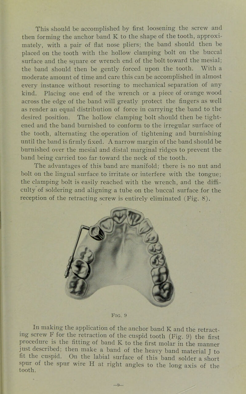 This should be accomplished by first loosening the screw and then forming the anchor band K to the shape of the tooth, approxi- mately, with a pair of flat nose pliers; the band should then be placed on the tooth with the hollow clamping bolt on the buccal surface and the square or wrench end of the bolt toward the mesial; the band should then be gently forced upon the tooth. With a moderate amount of time and care this can be accomplished in almost every instance without resorting to mechanical separation of any kind. Placing one end of the wrench or a piece of orange wood across the edge of the band will greatly protect the fingers as well as render an equal distribution of force in carrying the baud to the desired position. The hollow clamping bolt should then be tight- ened and the band burnished to conform to the irregular surface of the tooth, alternating the operation of tightening and burnishing until the band is firmly fixed. A narrow margin of the band should be burnished over the mesial and distal marginal ridges to prevent the band being carried too far toward the neck of the tooth. The advantages of this band are manifold; there is no nut and bolt on the lingual surface to irritate or interfere with the tongue; the clamping bolt is easily reached with the wrench, and the diffi- culty of soldering and aligning a tube on the buccal surface for the reception of the retracting screw is entirely eliminated (Fig. 8). Fig. !) In making the application of the anchor band K and the retract- ing screw F for the retraction of the cuspid tooth (Fig. 9) the first procedure is the fitting of band K to the first molar in the manner just described; then make a band of the heavy band material J to fit the cuspid. On the labial surface of this band solder a short spur of the spur wire H at right angles to the long axis of the tooth. —9—