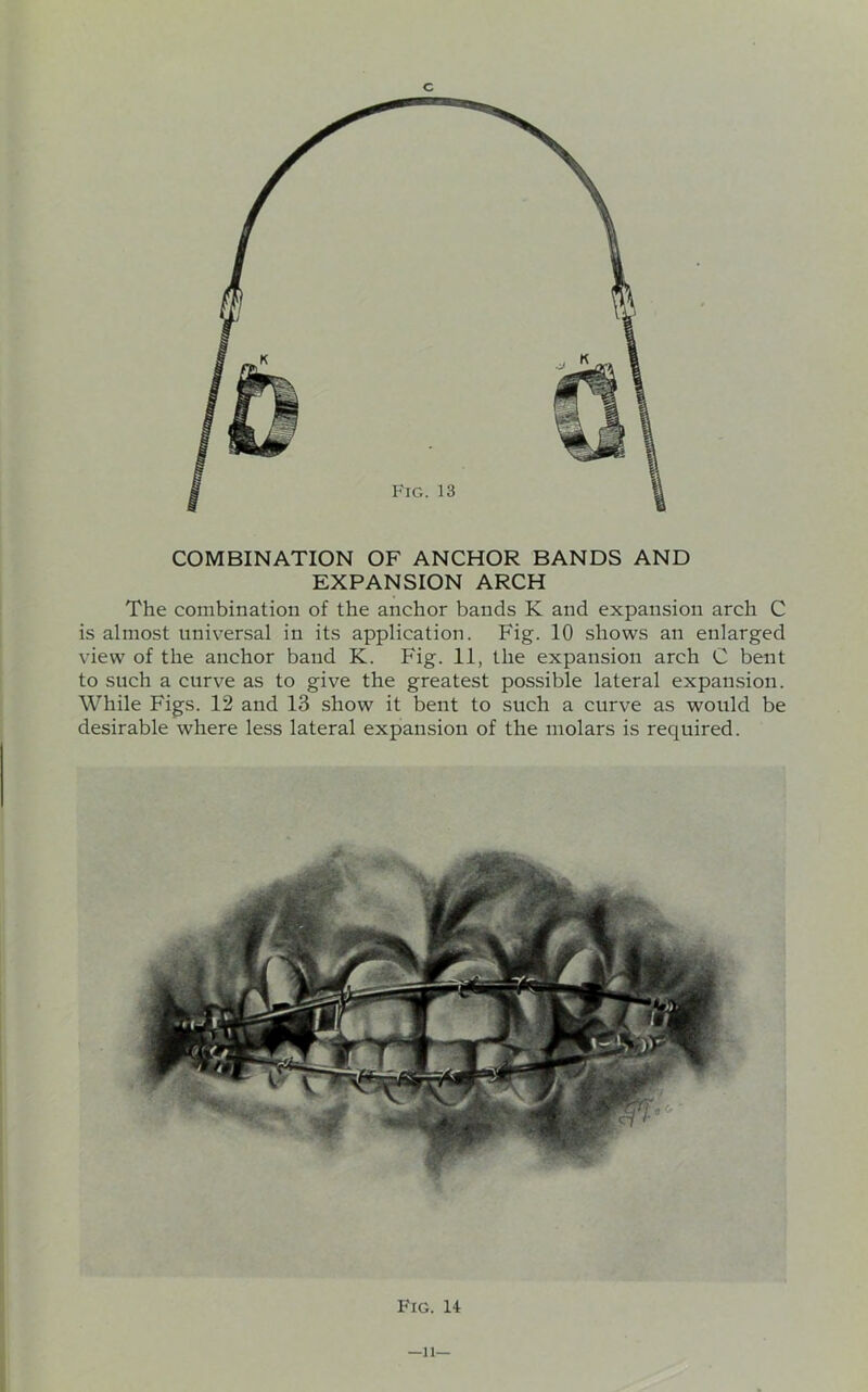 COMBINATION OF ANCHOR BANDS AND EXPANSION ARCH The combination of the anchor bands K and expansion arch C is almost universal in its application. Fig. 10 shows an enlarged view of the anchor band K. Fig. 11, the expansion arch C bent to such a curve as to give the greatest possible lateral expansion. While Figs. 12 and 13 show it bent to such a curve as would be desirable where less lateral expansion of the molars is required. Fig. 14 —li—