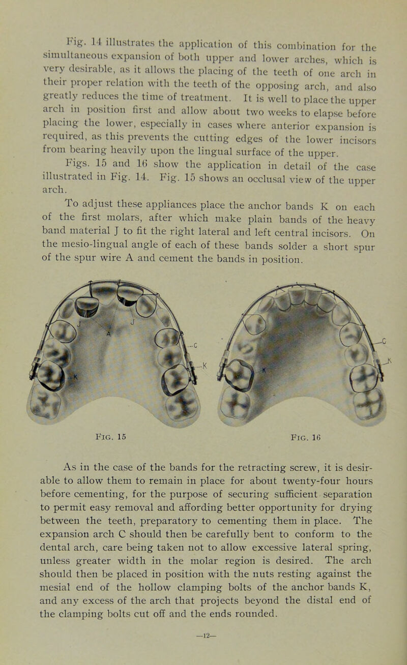 Fig. 14 illustrates the application of this combination for the simultaneous expansion of both upper and lower arches, which is very desirable, as it allows the placing of the teeth of one arch in theii proper relation with the teeth of the opposing arch, and also greatly reduces the time of treatment. It is well to place the upper arch in position first and allow about two weeks to elapse before placing the lower, especially in cases where anterior expansion is required, as this prevents the cutting edges of the lower incisors from bearing heavily upon the lingual surface of the upper. Figs. 15 and 1(5 show the application in detail of the case illustrated in Fig. 14. Fig. 15 shows an occlusal view of the upper arch. To adjust these appliances place the anchor bands K on each of the first molars, after which make plain bands of the heavy band material J to fit the right lateral and left central incisors. On the mesio-lingual angle of each of these bands solder a short spur of the spur wire A and cement the bands in position. As in the case of the bands for the retracting screw, it is desir- able to allow them to remain in place for about twenty-four hours before cementing, for the purpose of securing sufficient separation to permit easy removal and affording better opportunity for drying between the teeth, preparatory to cementing them in place. The expansion arch C should then be carefully bent to conform to the dental arch, care being taken not to allow excessive lateral spring, unless greater width in the molar region is desired. The arch should then be placed in position with the nuts resting against the mesial end of the hollow clamping bolts of the anchor bands K, and any excess of the arch that projects beyond the distal end of the clamping bolts cut off and the ends rounded. 12—